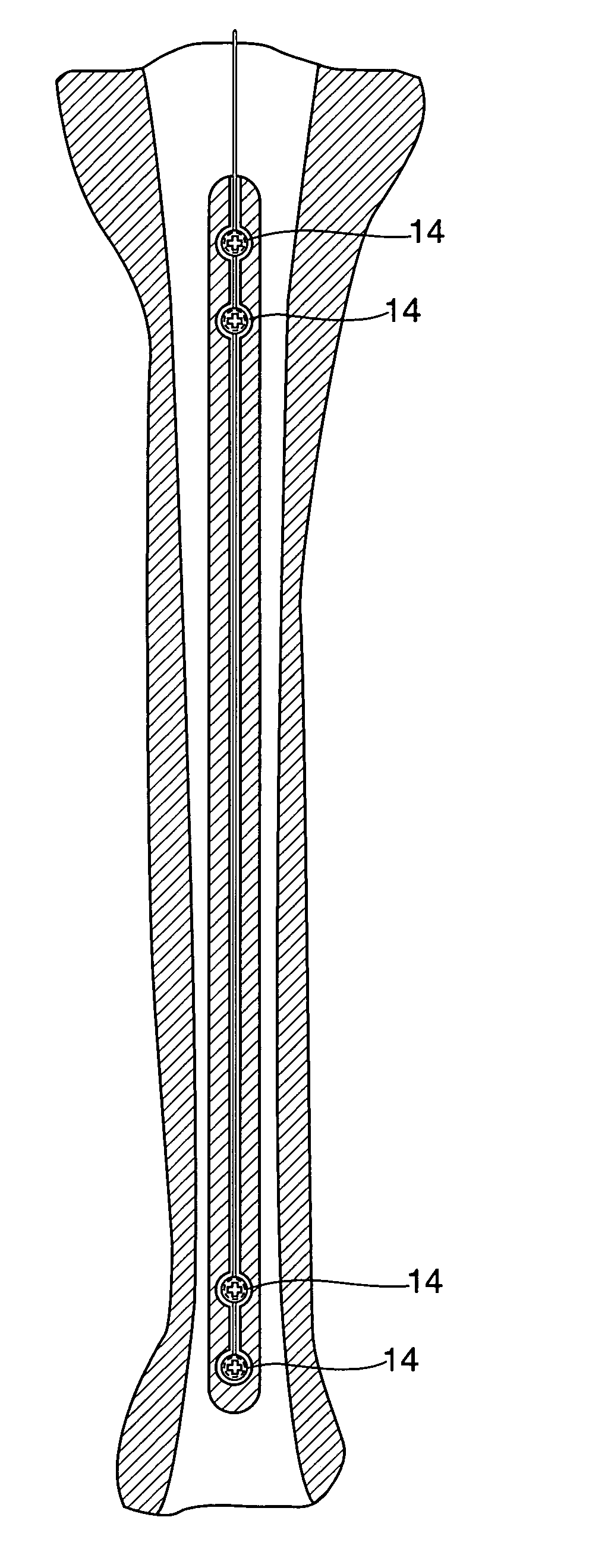 Interlocking IM Nails with threaded guidewire