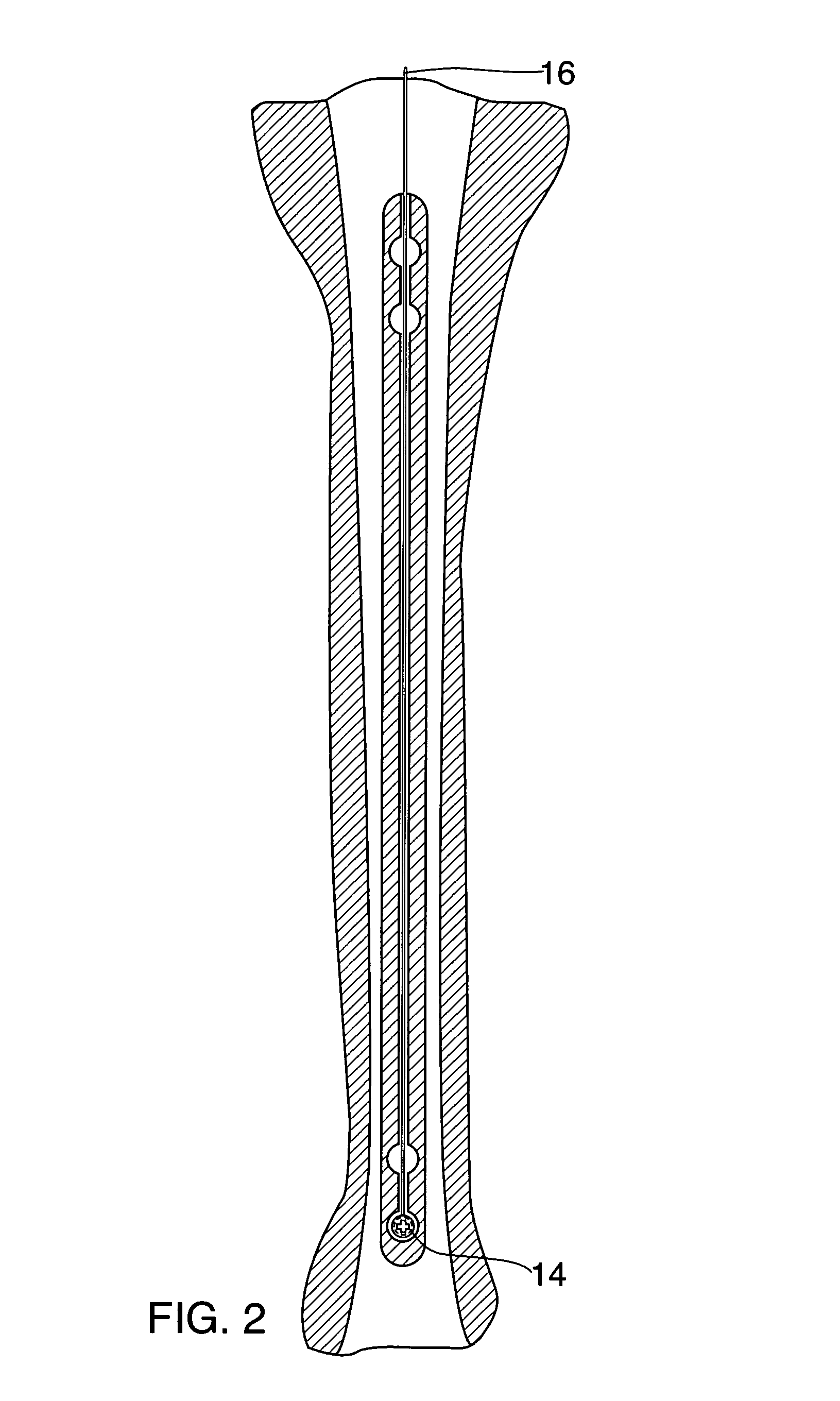 Interlocking IM Nails with threaded guidewire