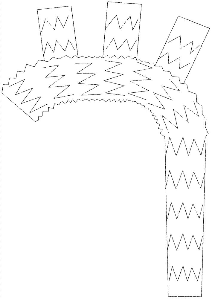 High-compliance three-branch stent used in aorta surgery