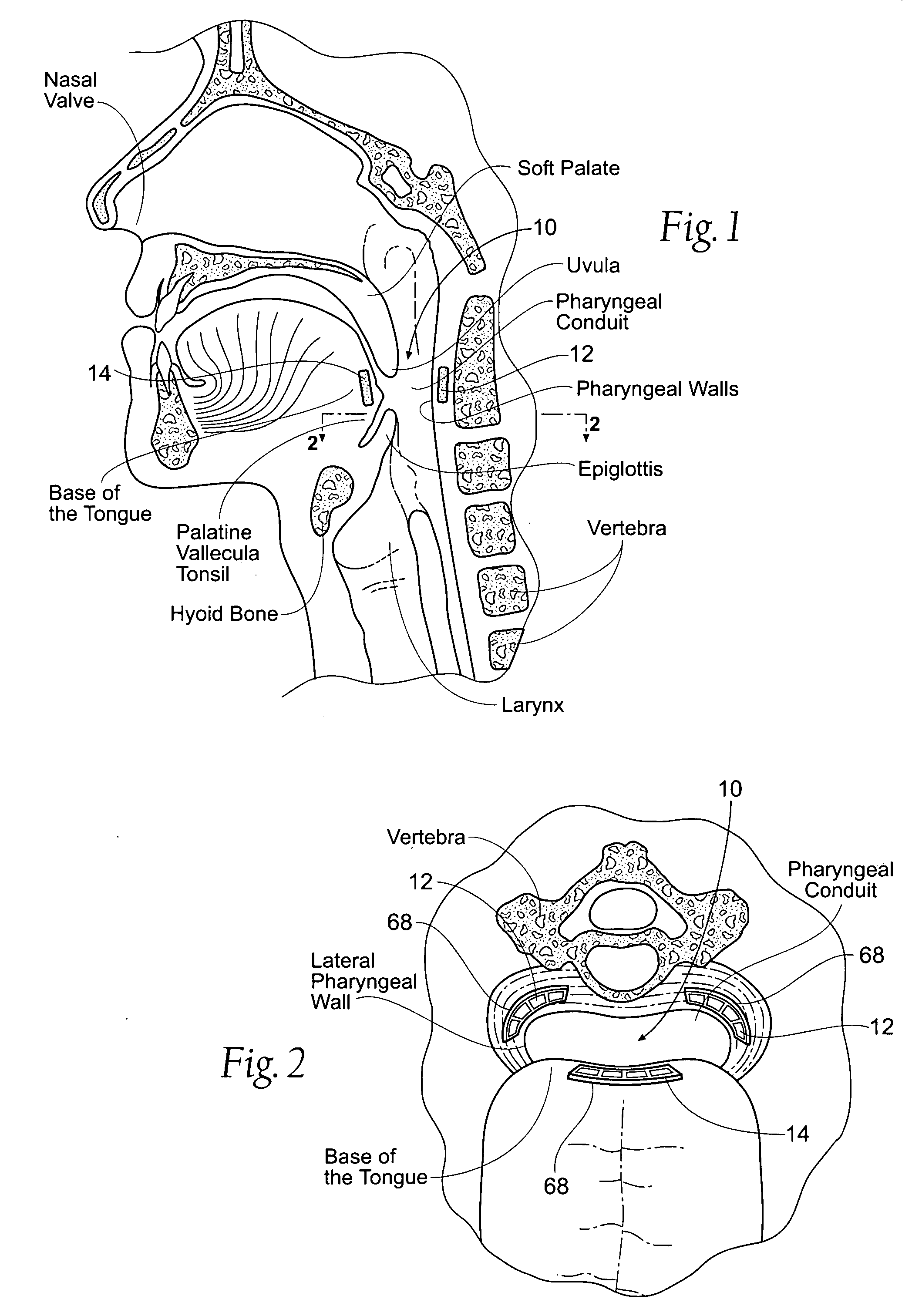 Devices, systems, and methods to fixate tissue within the regions of body, such as the pharyngeal conduit