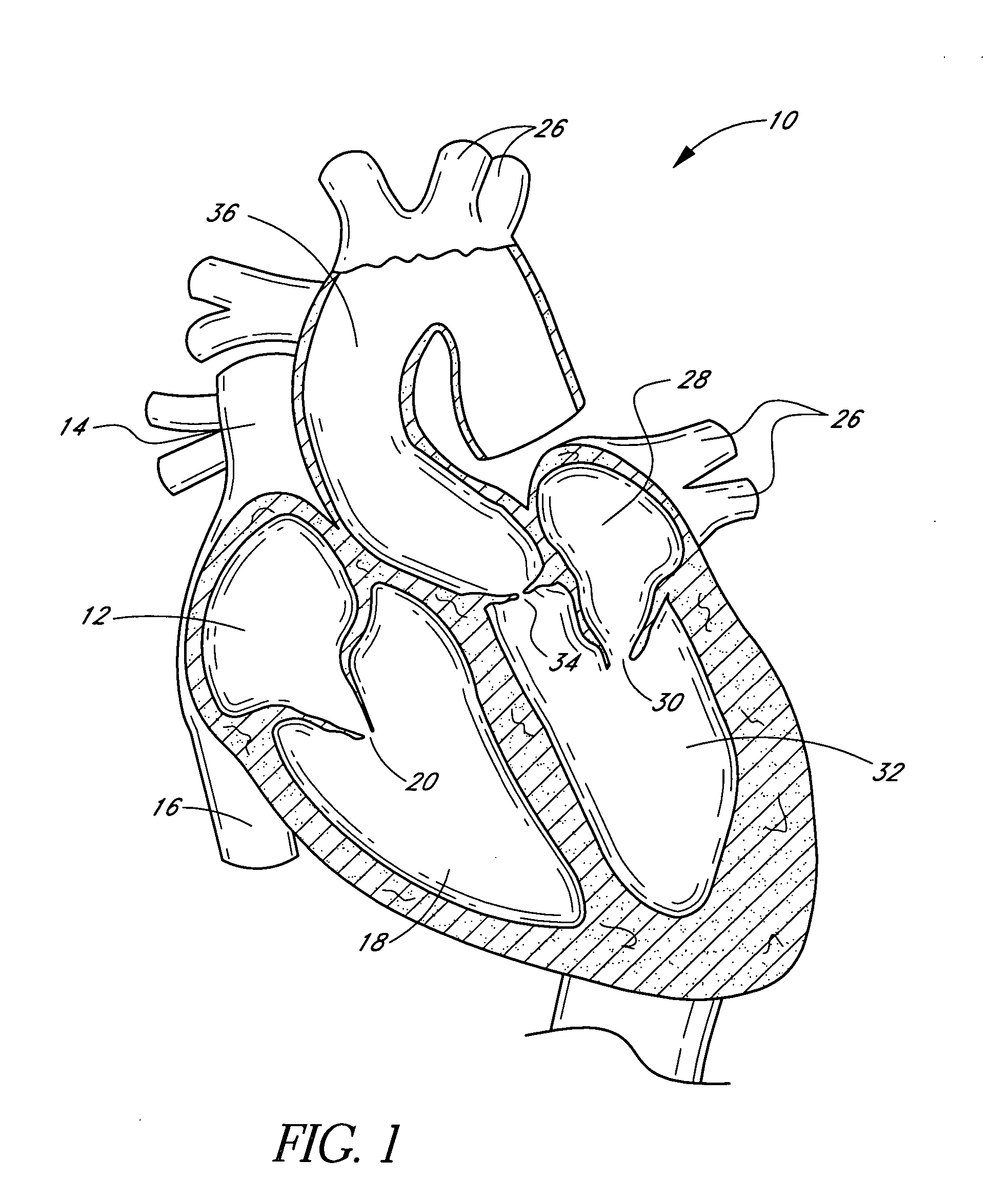 Nonstented temporary valve for cardiovascular therapy