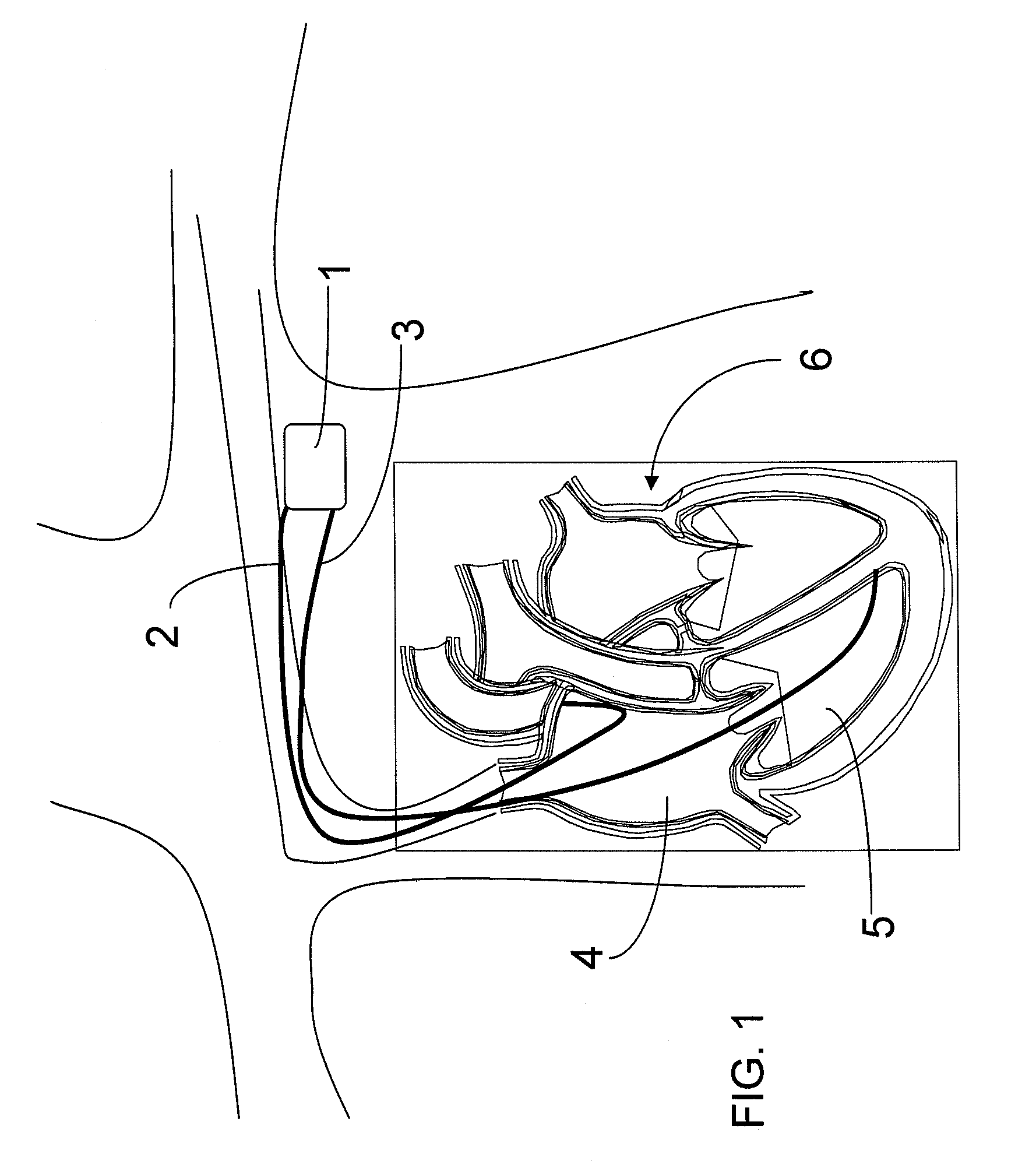 Apparatus and Associated Method for Facilitating Implantation of Leads of a Cardiac Pacemaker