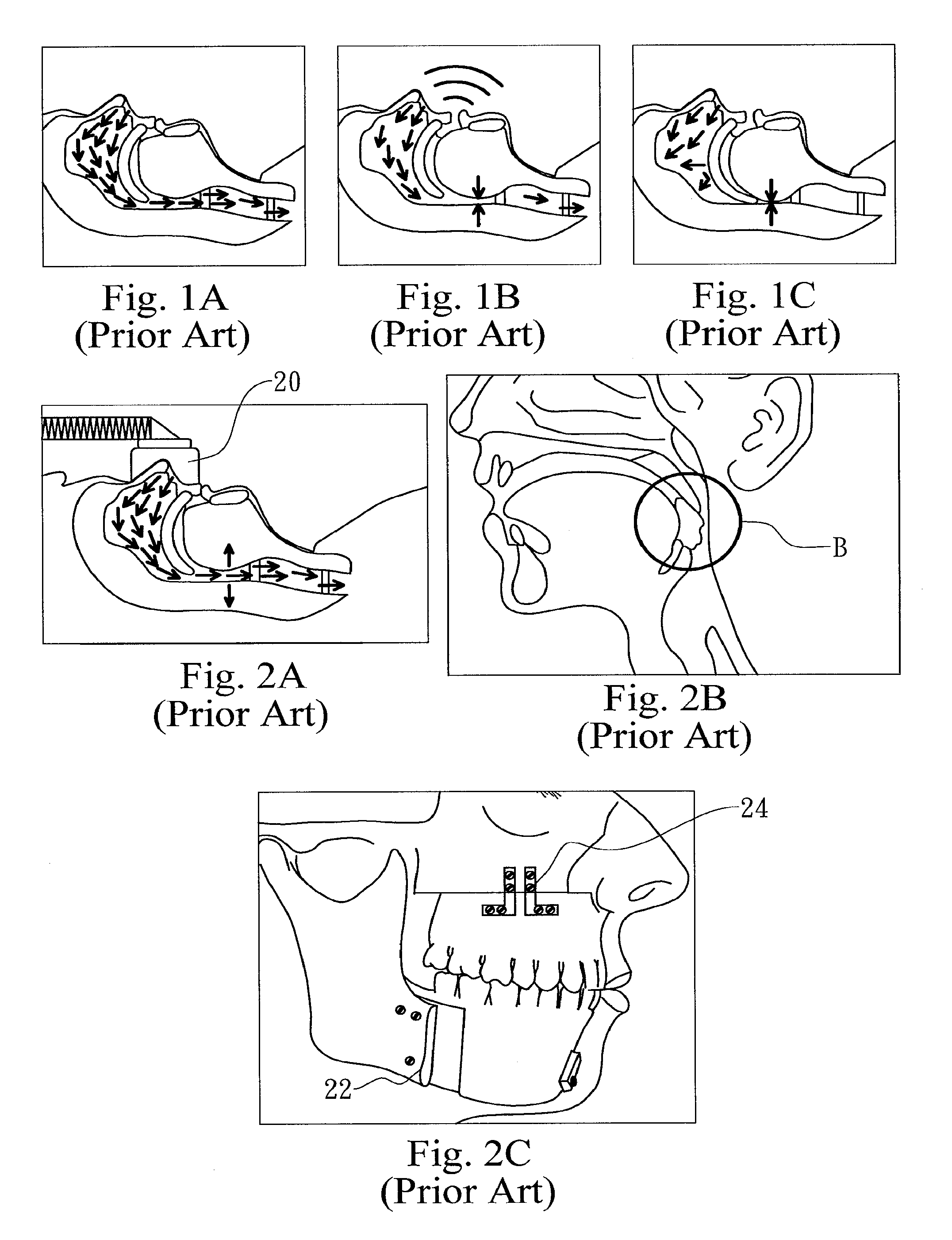 Method and apparatus for treating obstructive sleep apnea by using negative oral pressure to a patient