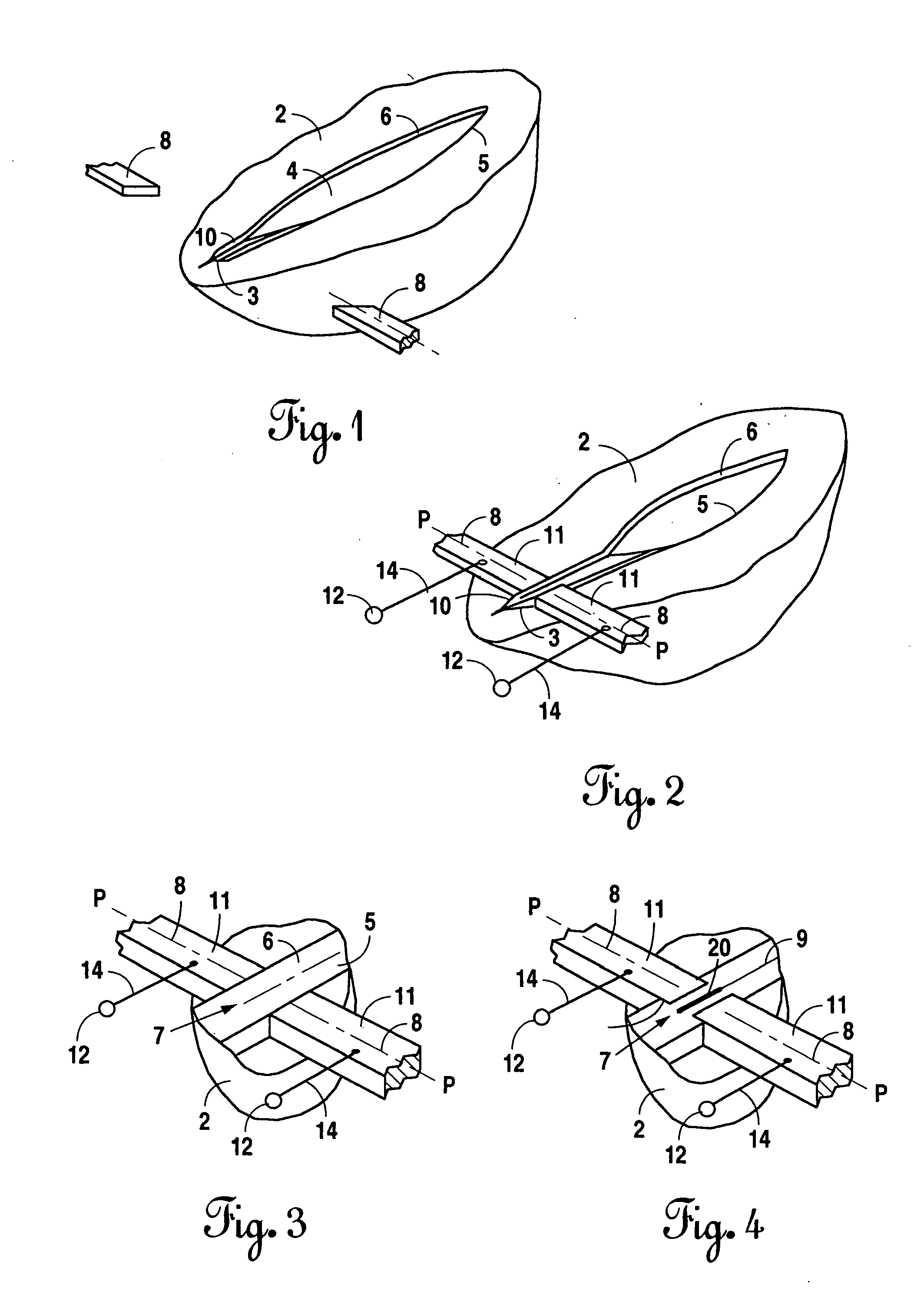 Bonding of soft biological tissues by passing high frequency electric current therethrough