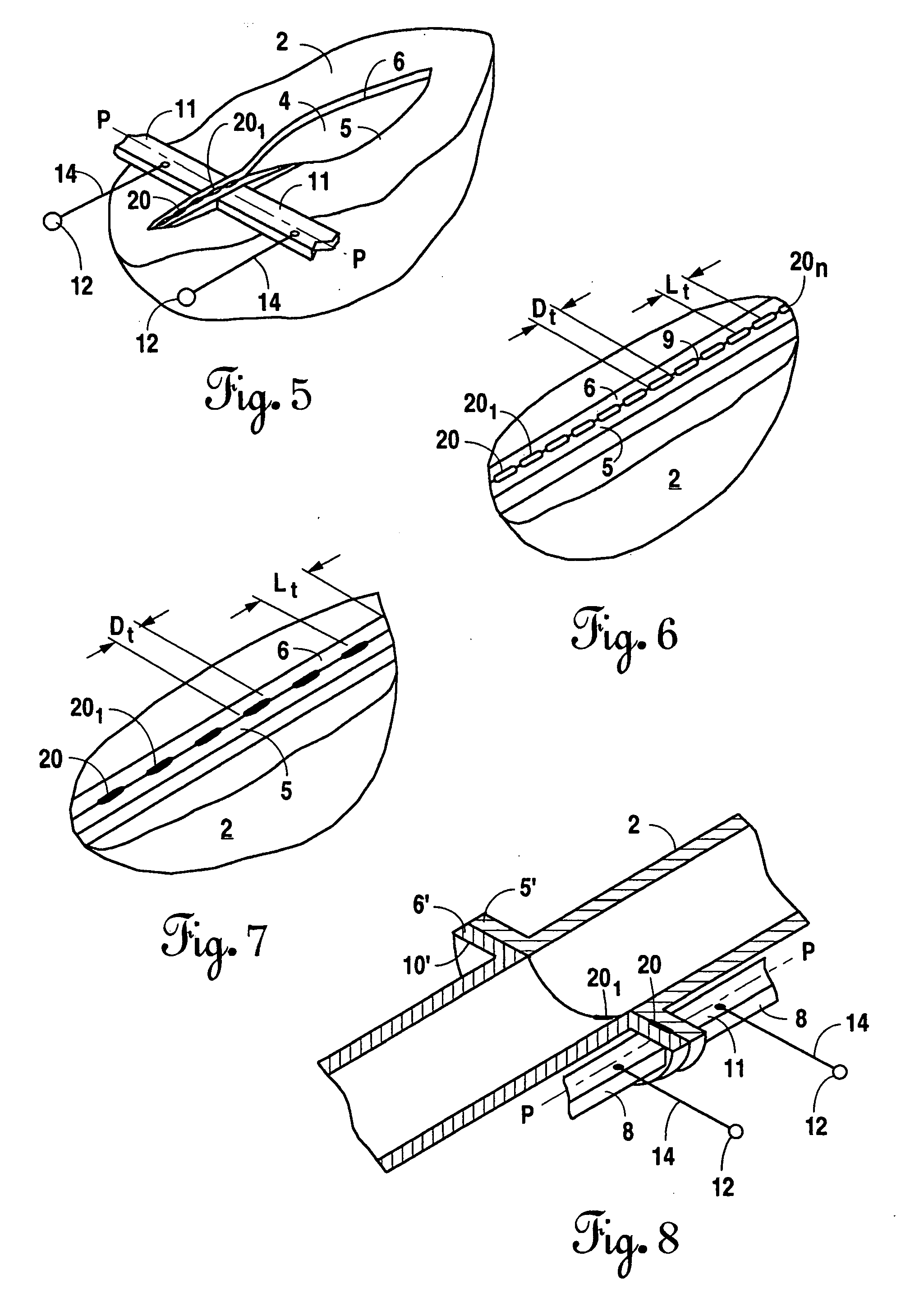 Bonding of soft biological tissues by passing high frequency electric current therethrough