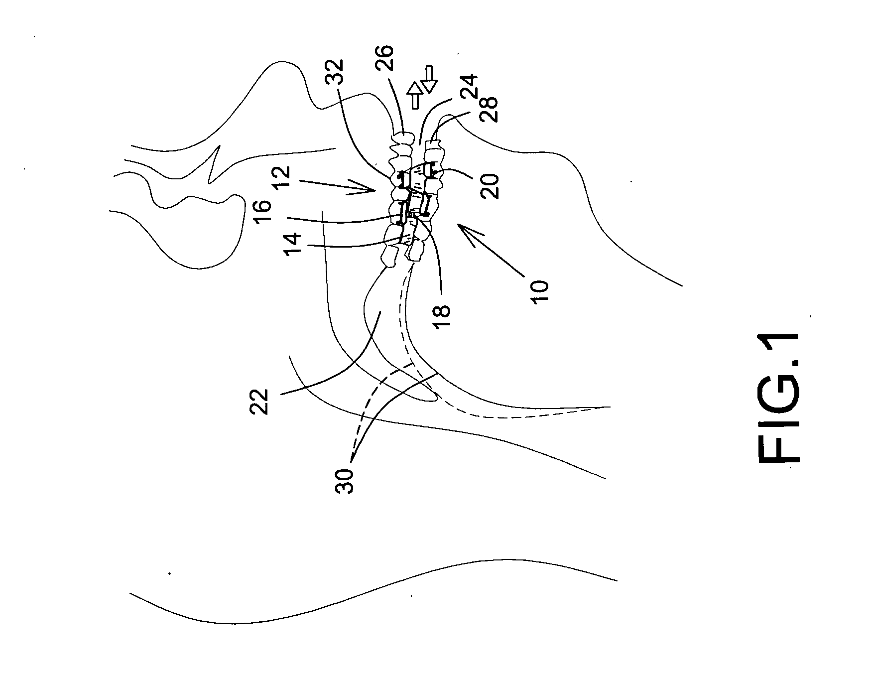 Anti-snoring apparatus