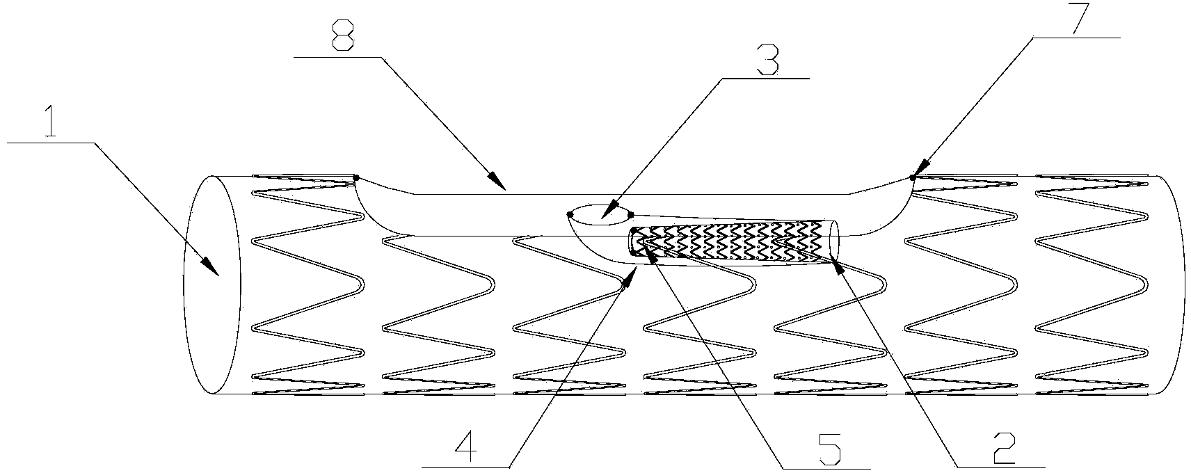 Stent graft