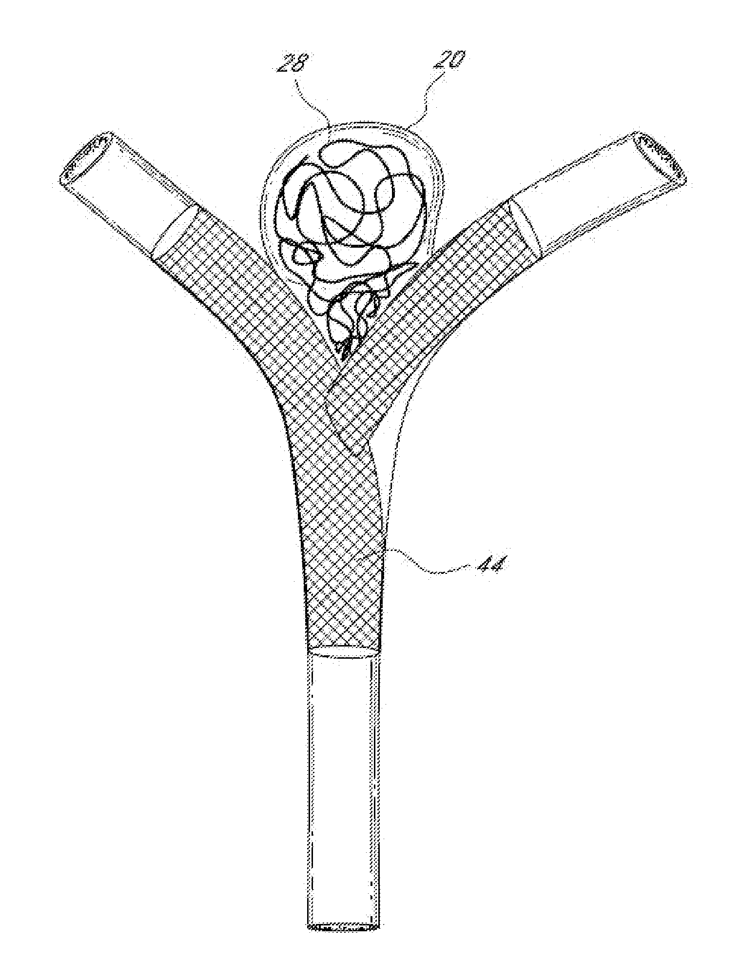 Vascular remodeling device