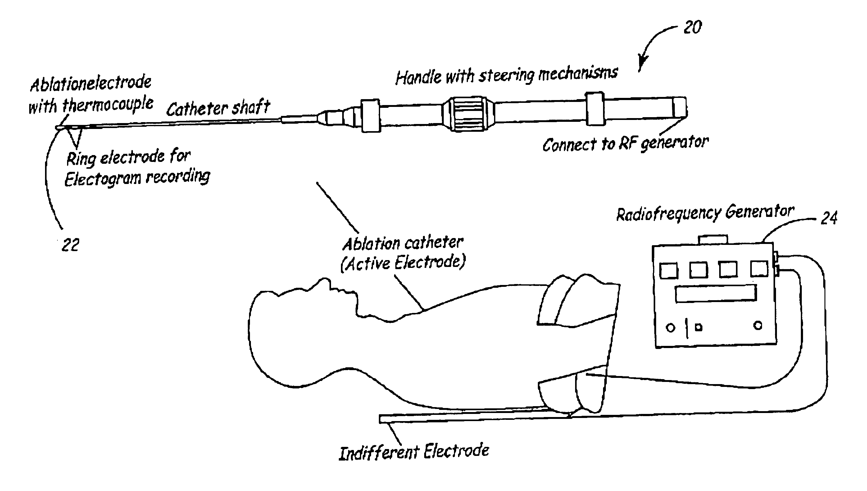 Medical ablation catheter control