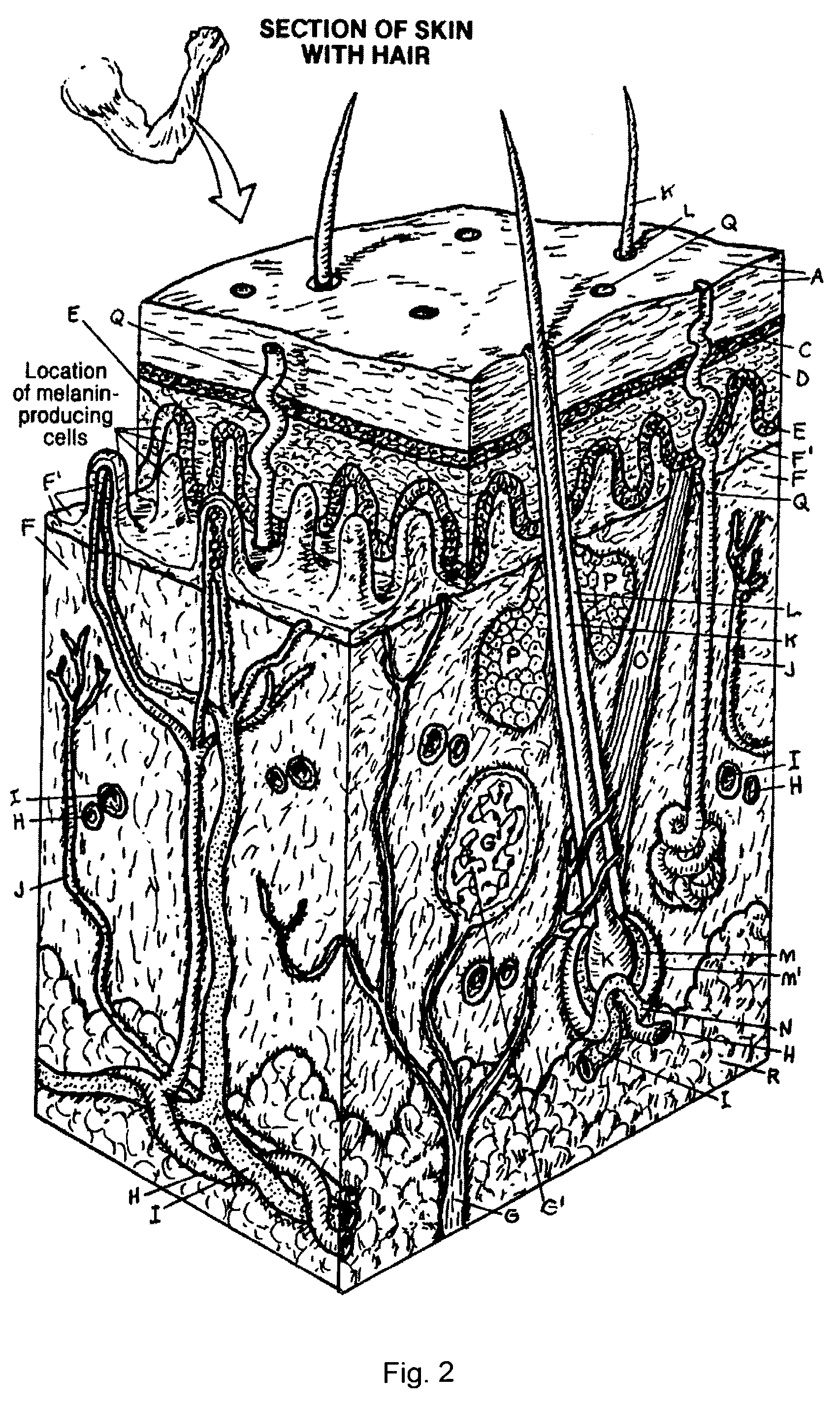 Percutaneous electrode array