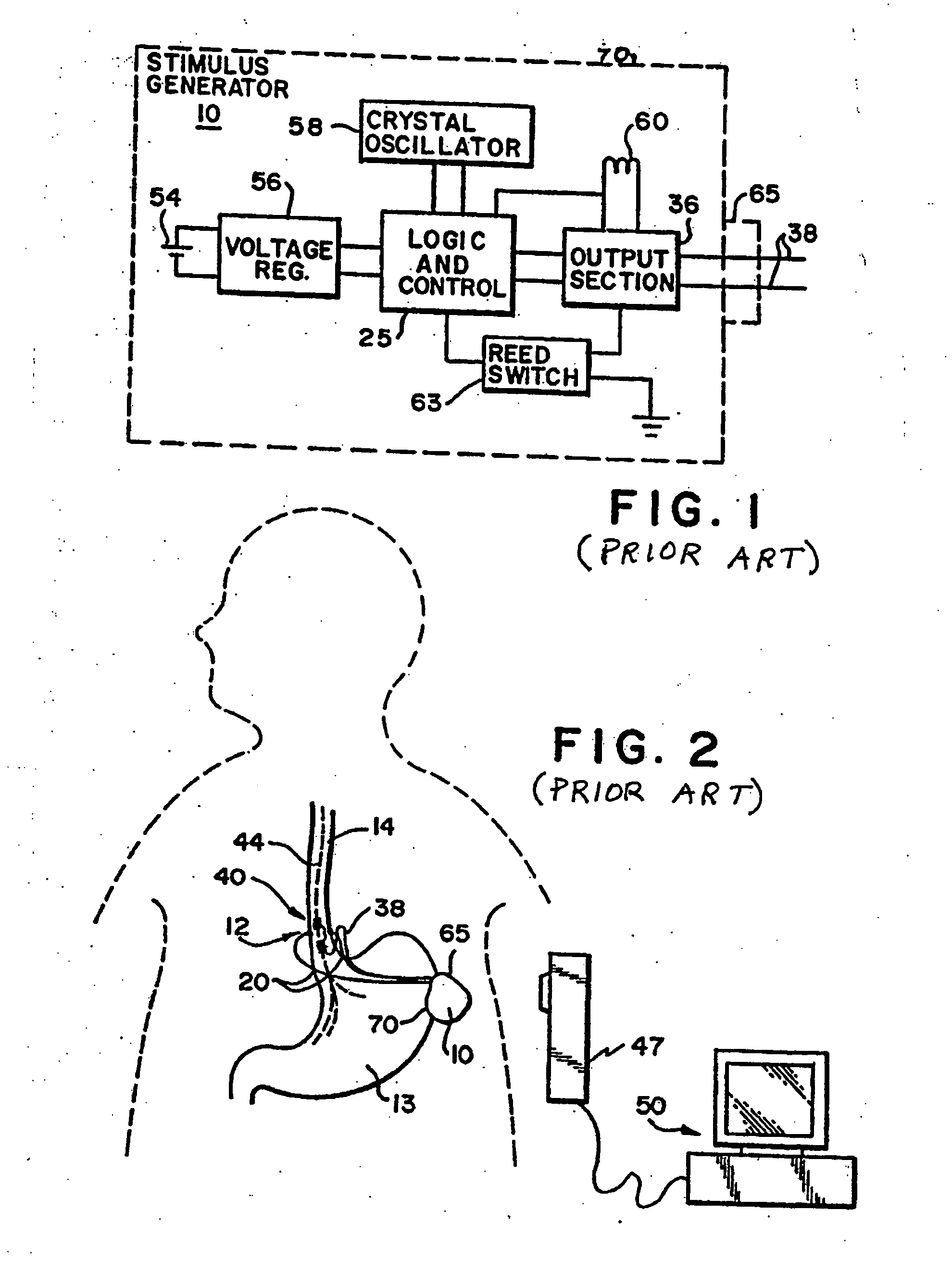 Obesity and eating disorder stimulation treatment with neural block