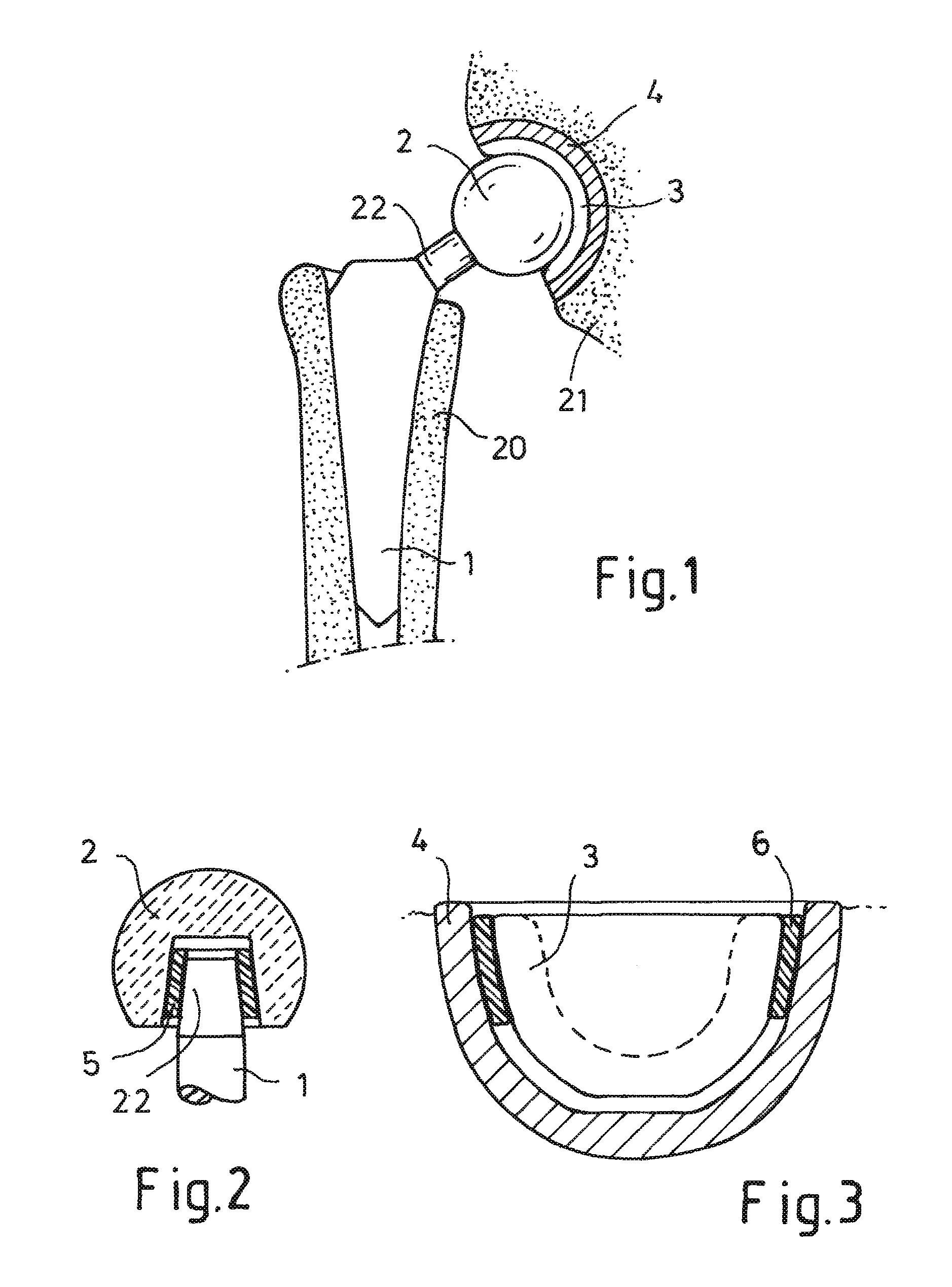 Insertion of vibration-damping elements in prosthetic systems for the manipulation and damping of natural frequencies