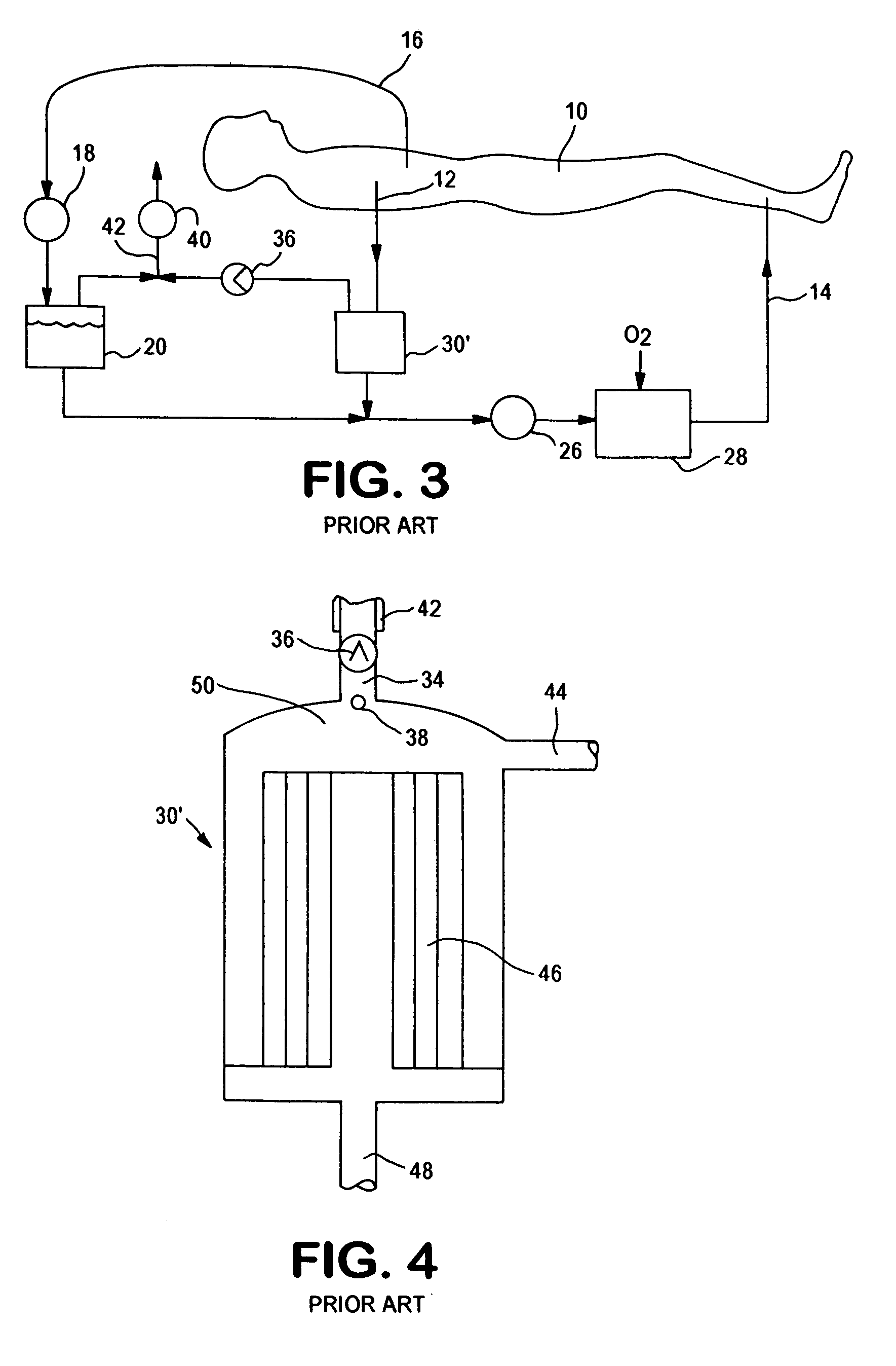 Active air removal from an extracorporeal blood circuit