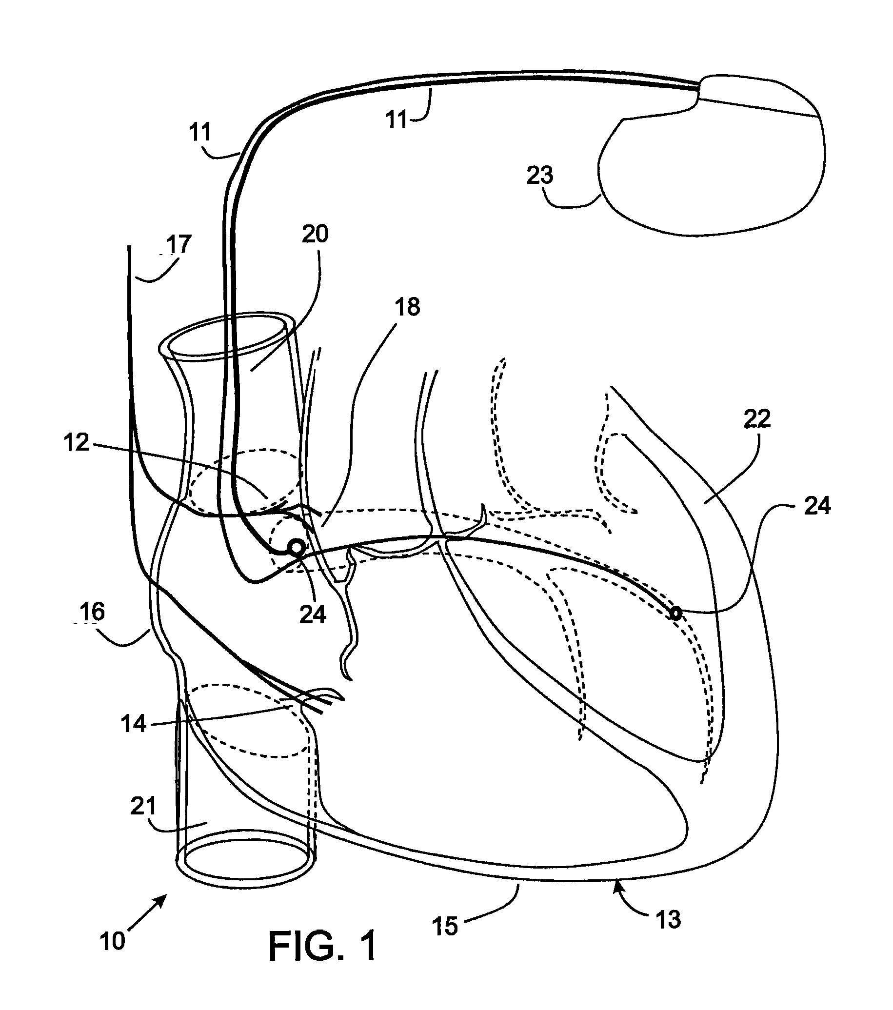 Implantable digital device for tissue stimulation