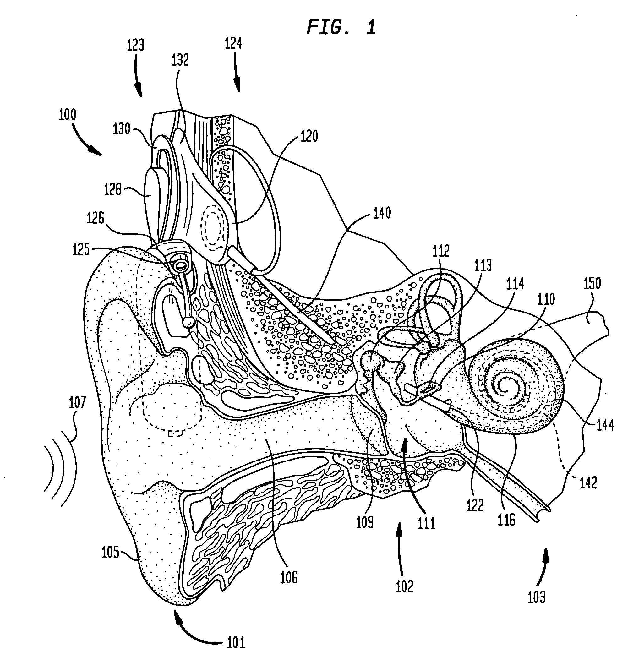 Prosthetic hearing implant fitting technique