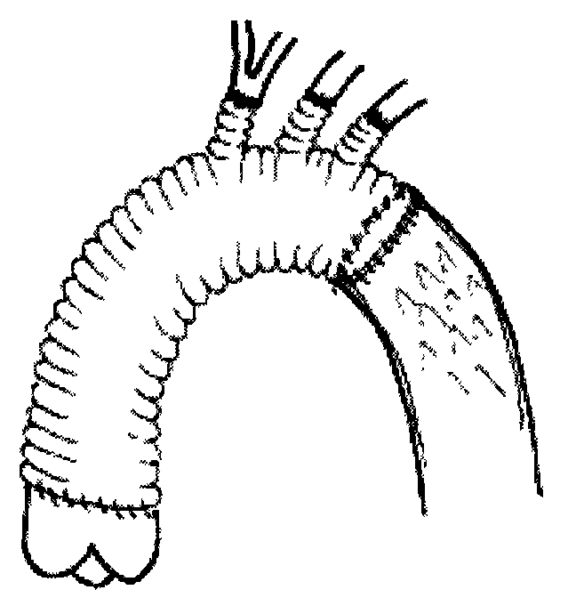 Improved support artificial blood vessel