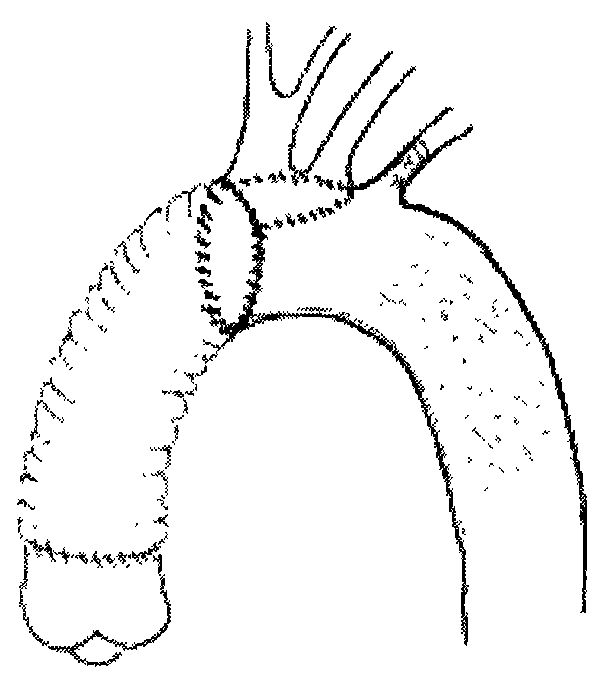 Improved support artificial blood vessel