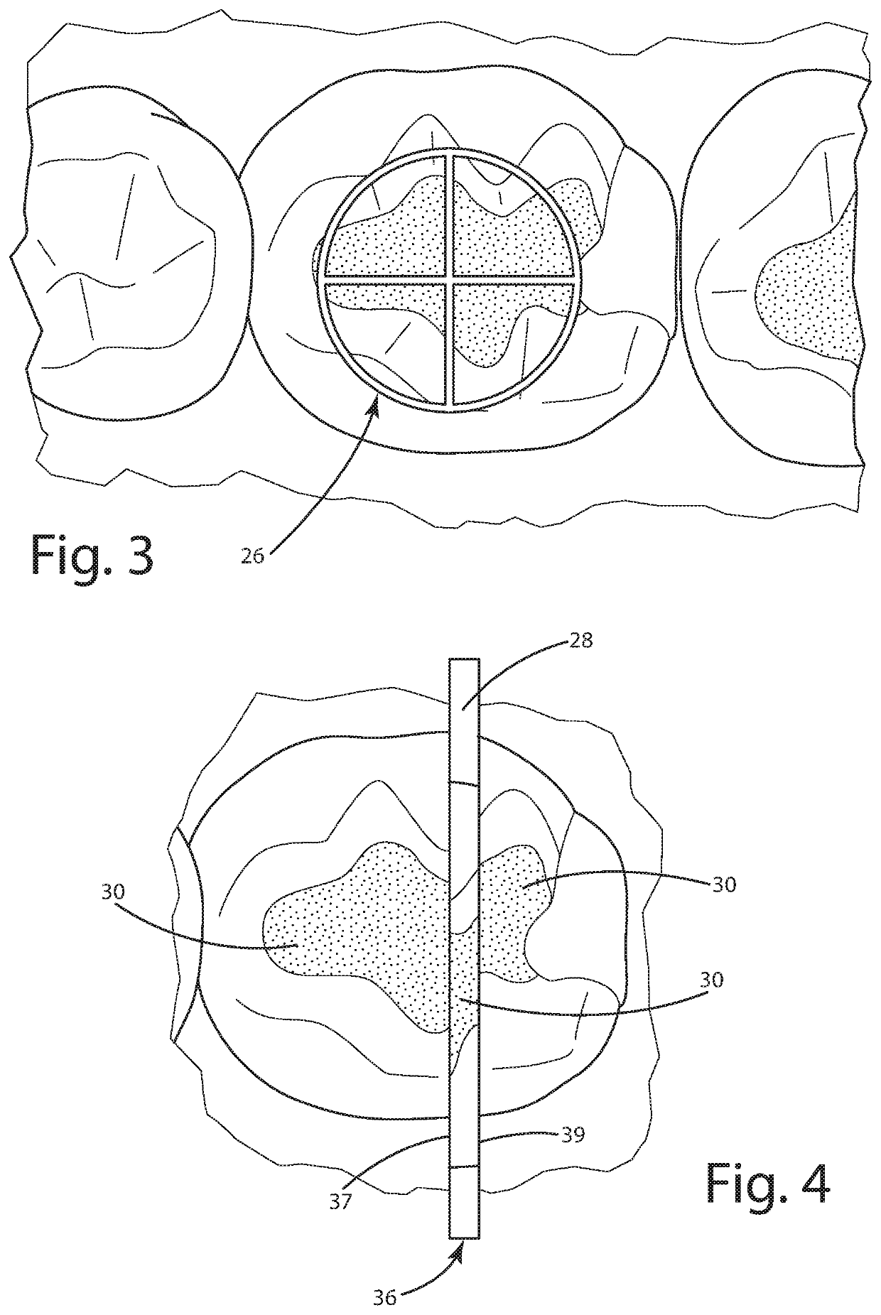 Dental curing light and method