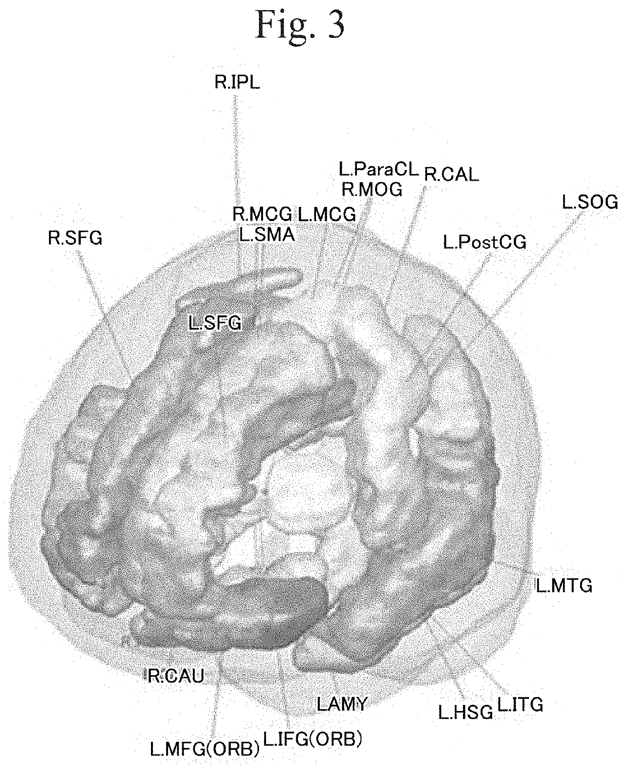 Brain activity analyzing apparatus, brain activity analyzing method, program and biomarker apparatus