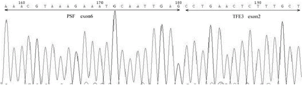 A probe combination and its application for diagnosis of xp11.2 translocation perivascular epithelioid cell tumor