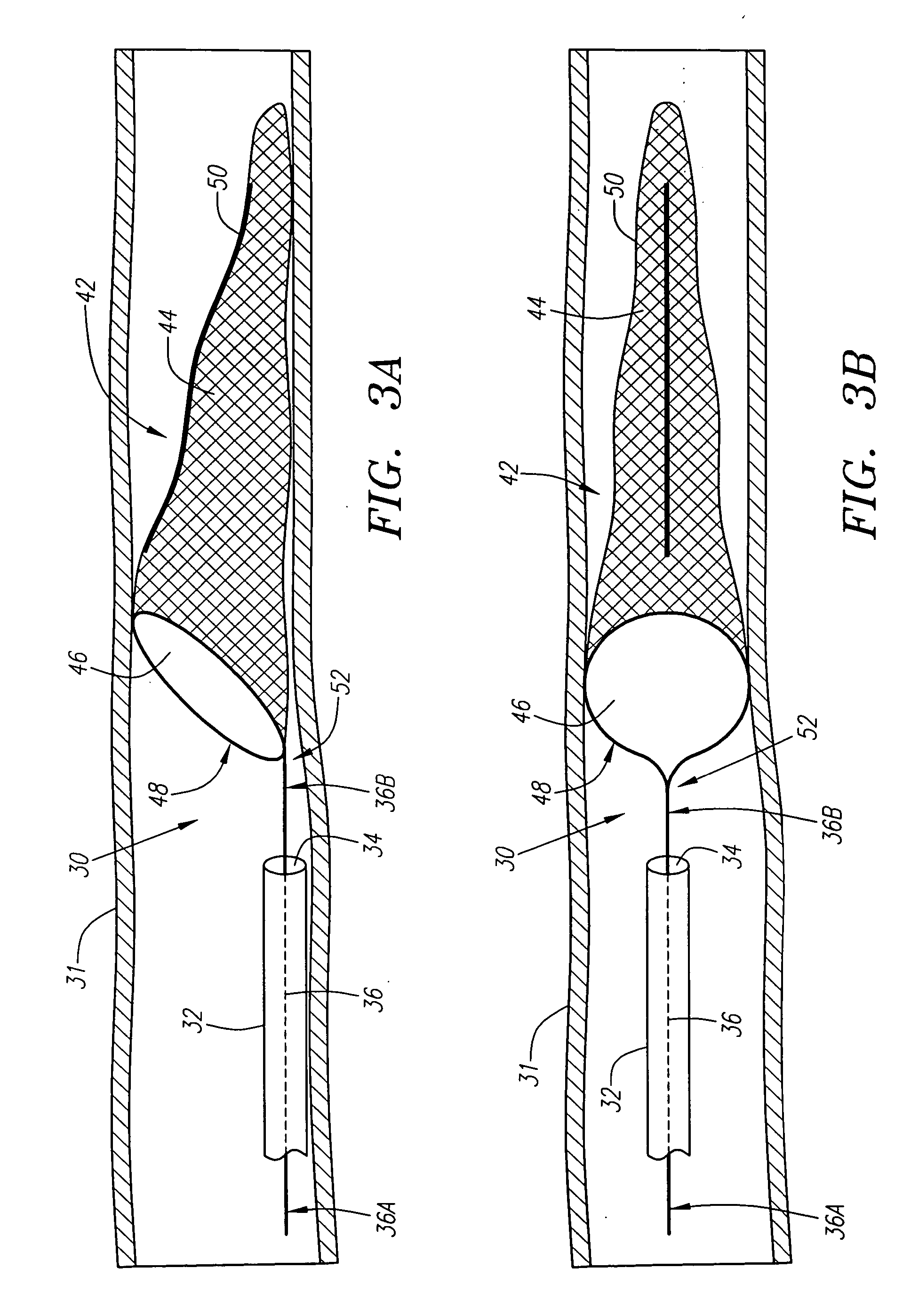 Method and assembly for distal embolic protection