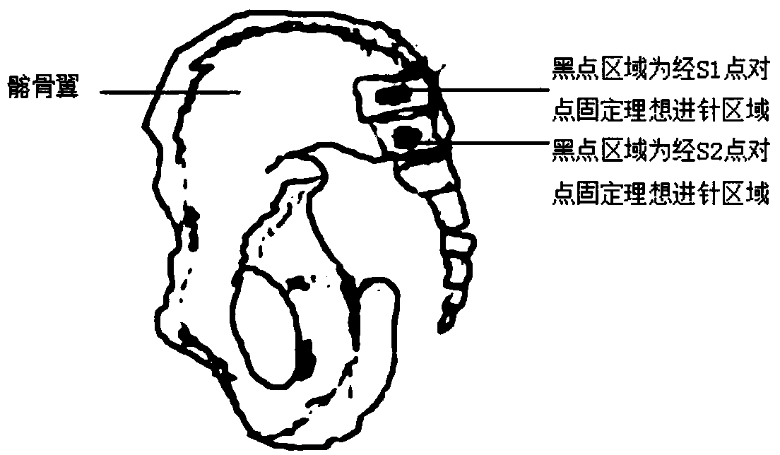 Sacroiliac joint through-screw positioning coaxial guide and assembly thereof