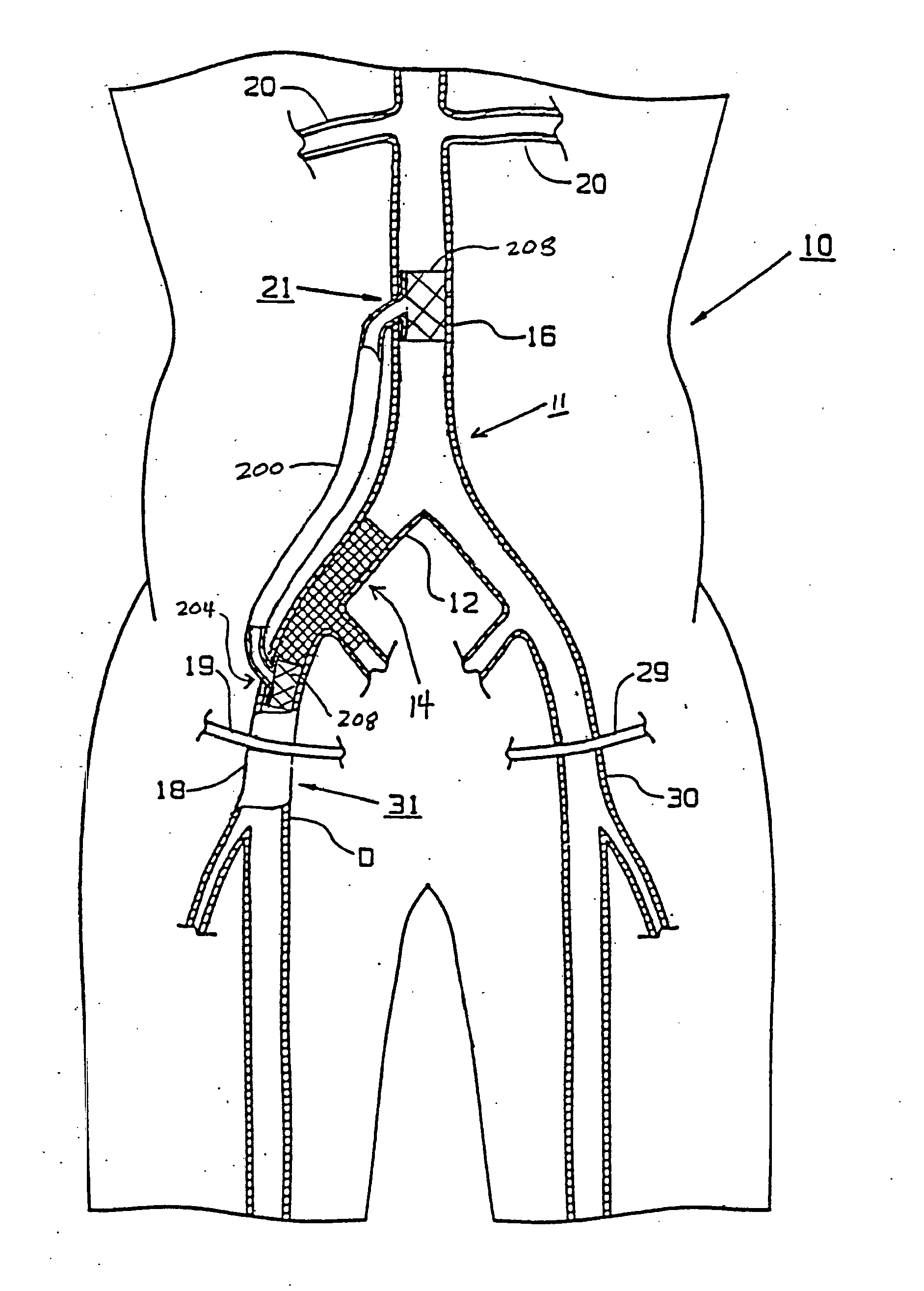 Bypass Grafting System and Apparatus