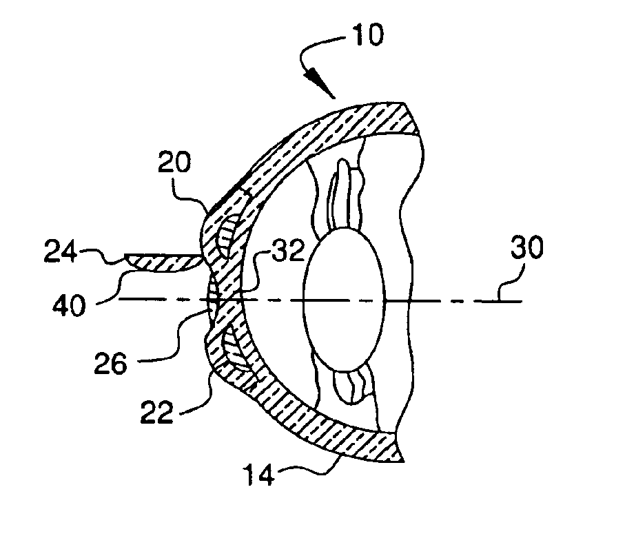 Gradual correction of corneal refractive error using multiple inlays