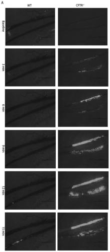 Application of CFTR gene to preparation of thrombotic disease early warning or diagnosing medicine