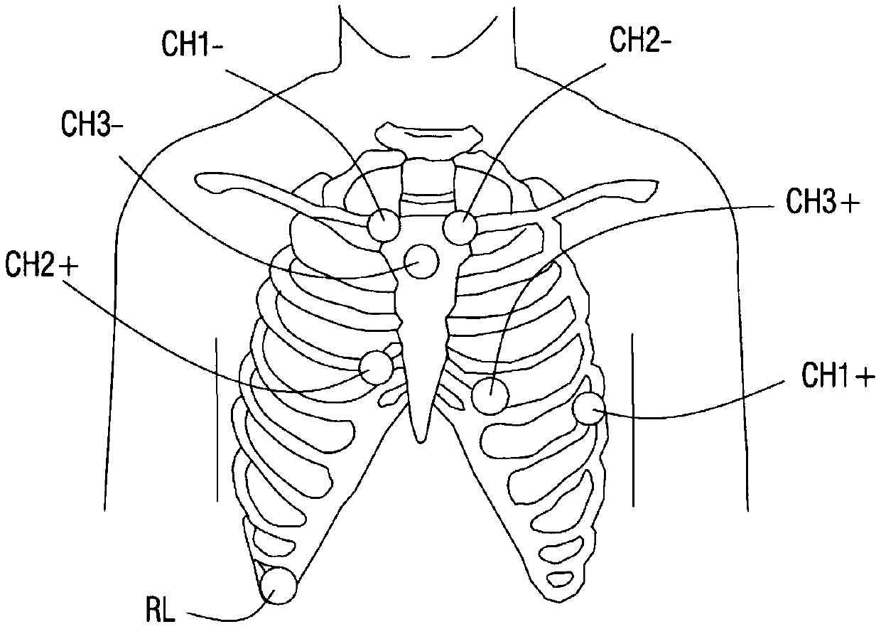 Three-lead ECG (electrocardiogram) monitoring system with electrode connection distinguishing function