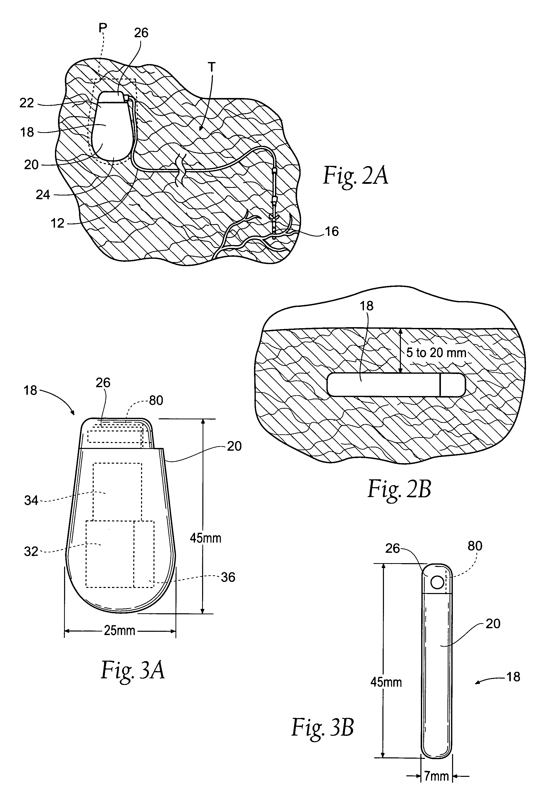 Implantable pulse generator systems and methods for providing functional and/or therapeutic stimulation of muscles and/or nerves and/or central nervous system tissue