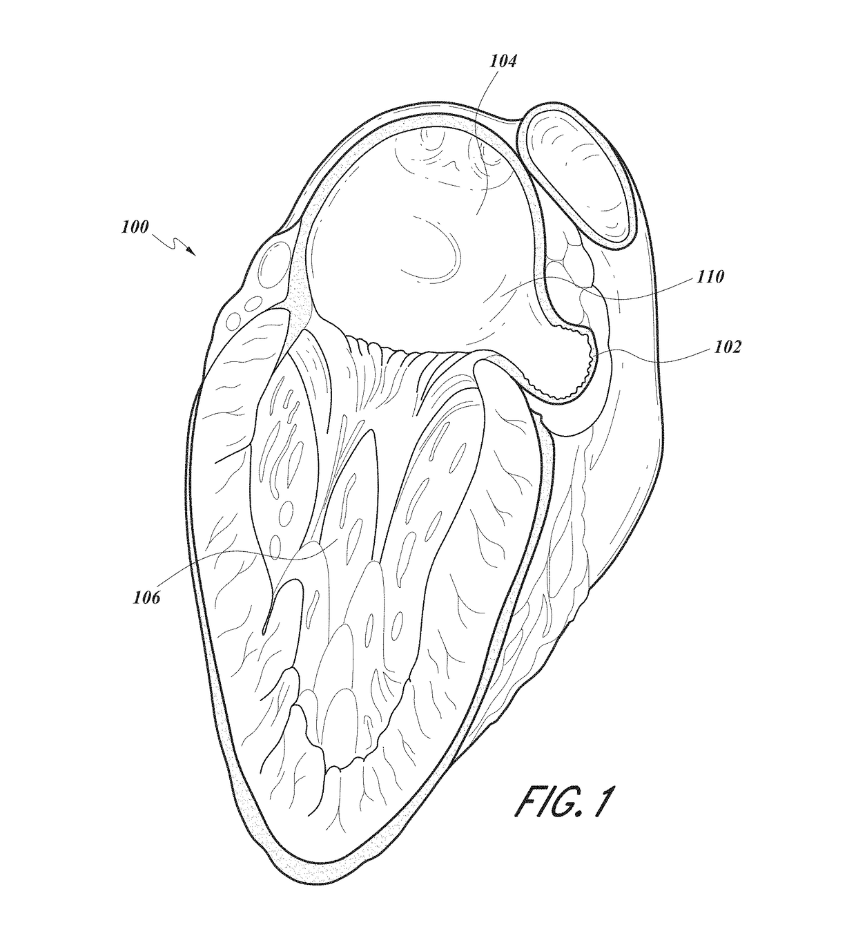 Devices and methods for excluding the left atrial appendage