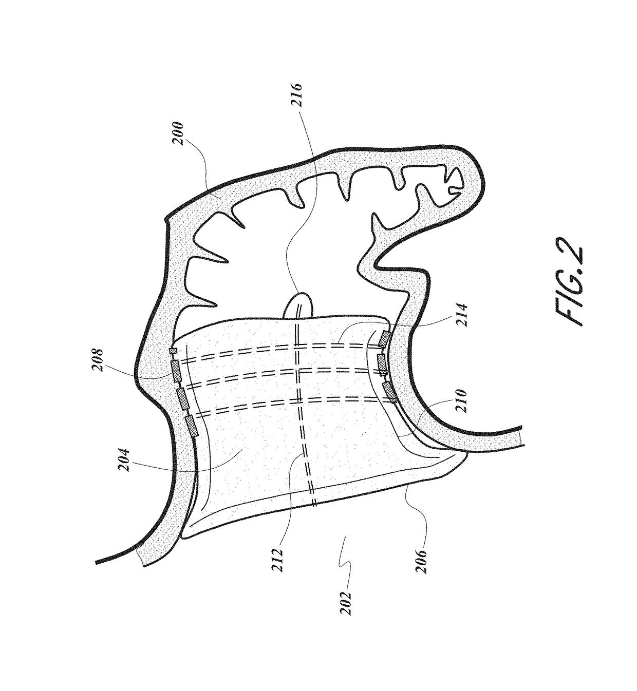 Devices and methods for excluding the left atrial appendage