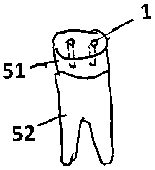 Dental implantation method and corresponding dental implant