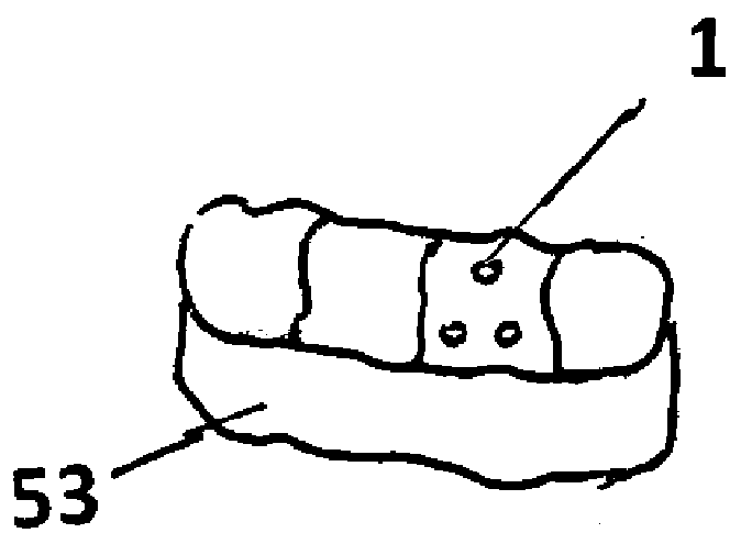 Dental implantation method and corresponding dental implant