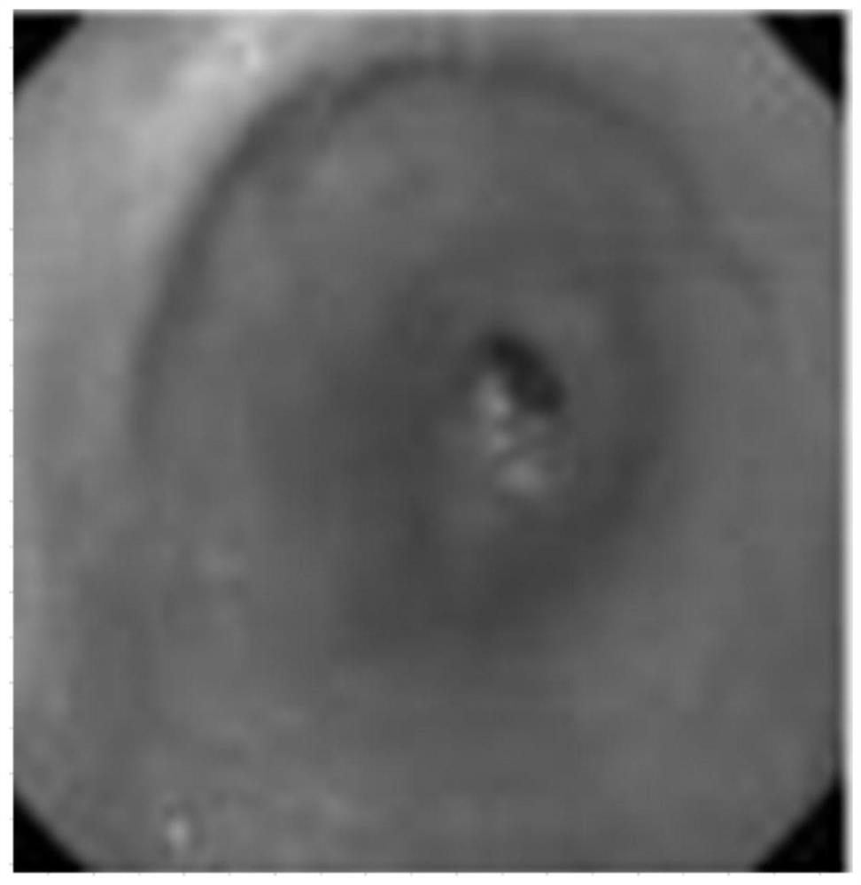 Image recognition system for distinguishing atrophic gastritis and gastric cancer, equipment and medium