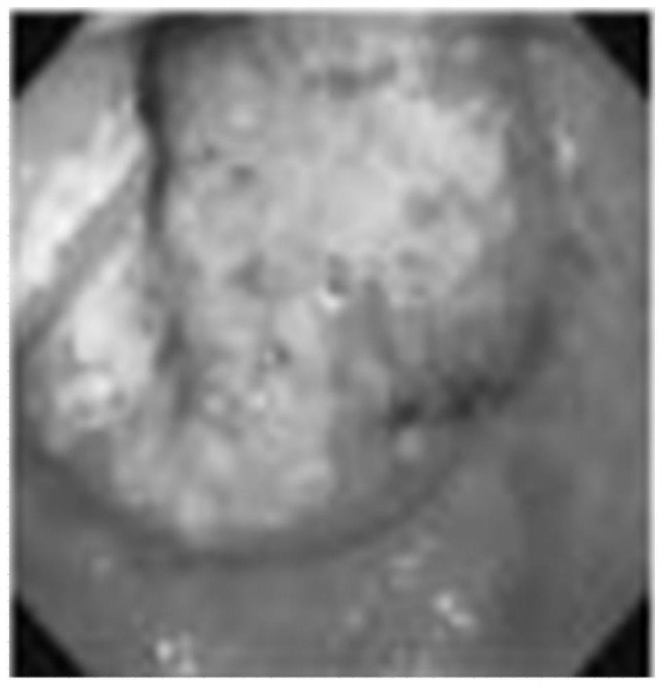 Image recognition system for distinguishing atrophic gastritis and gastric cancer, equipment and medium