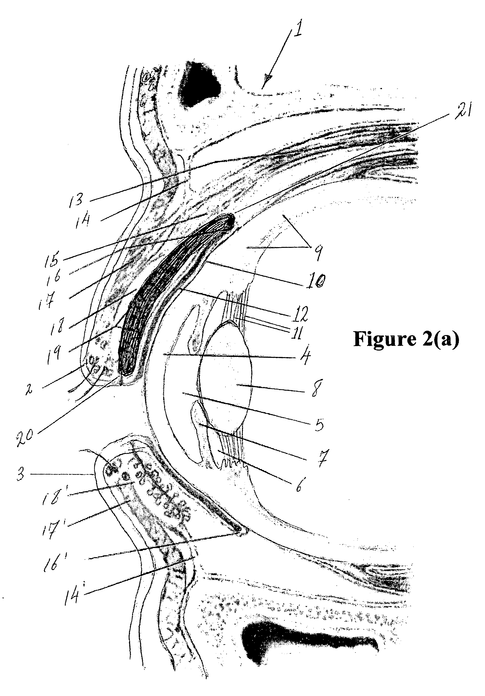 Surgical correction of ptosis polymeric artificial muscles