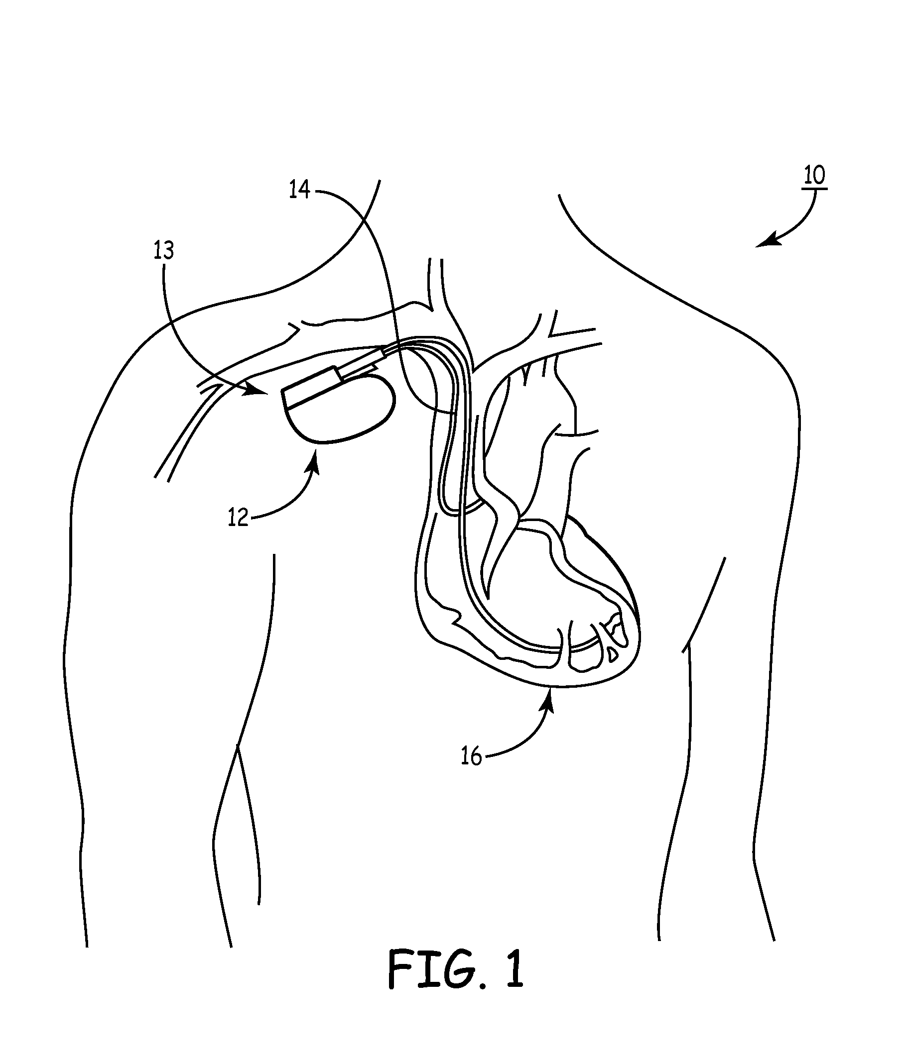 Resonance tuning module for implantable devices and leads