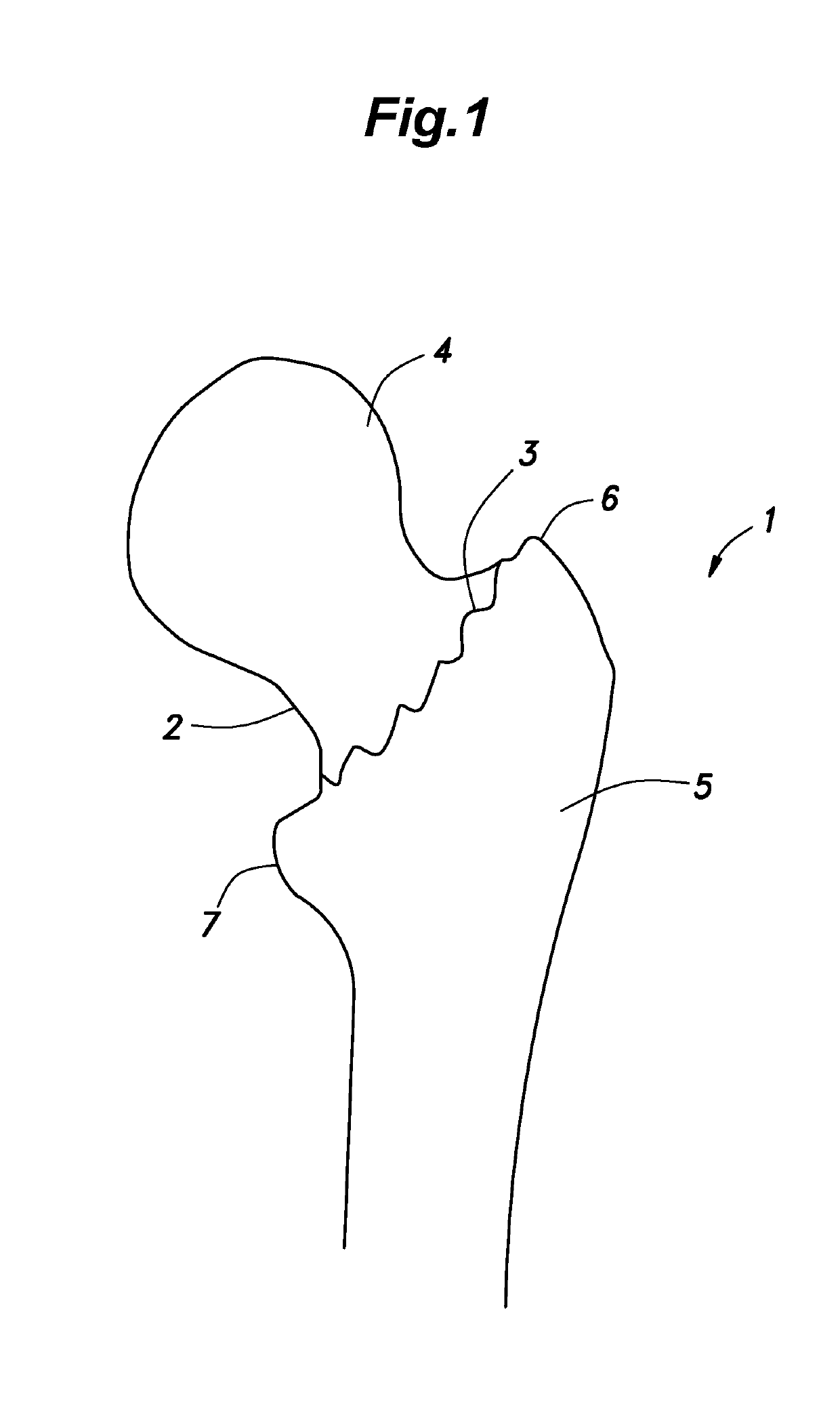 Internal fixator for bone fracture