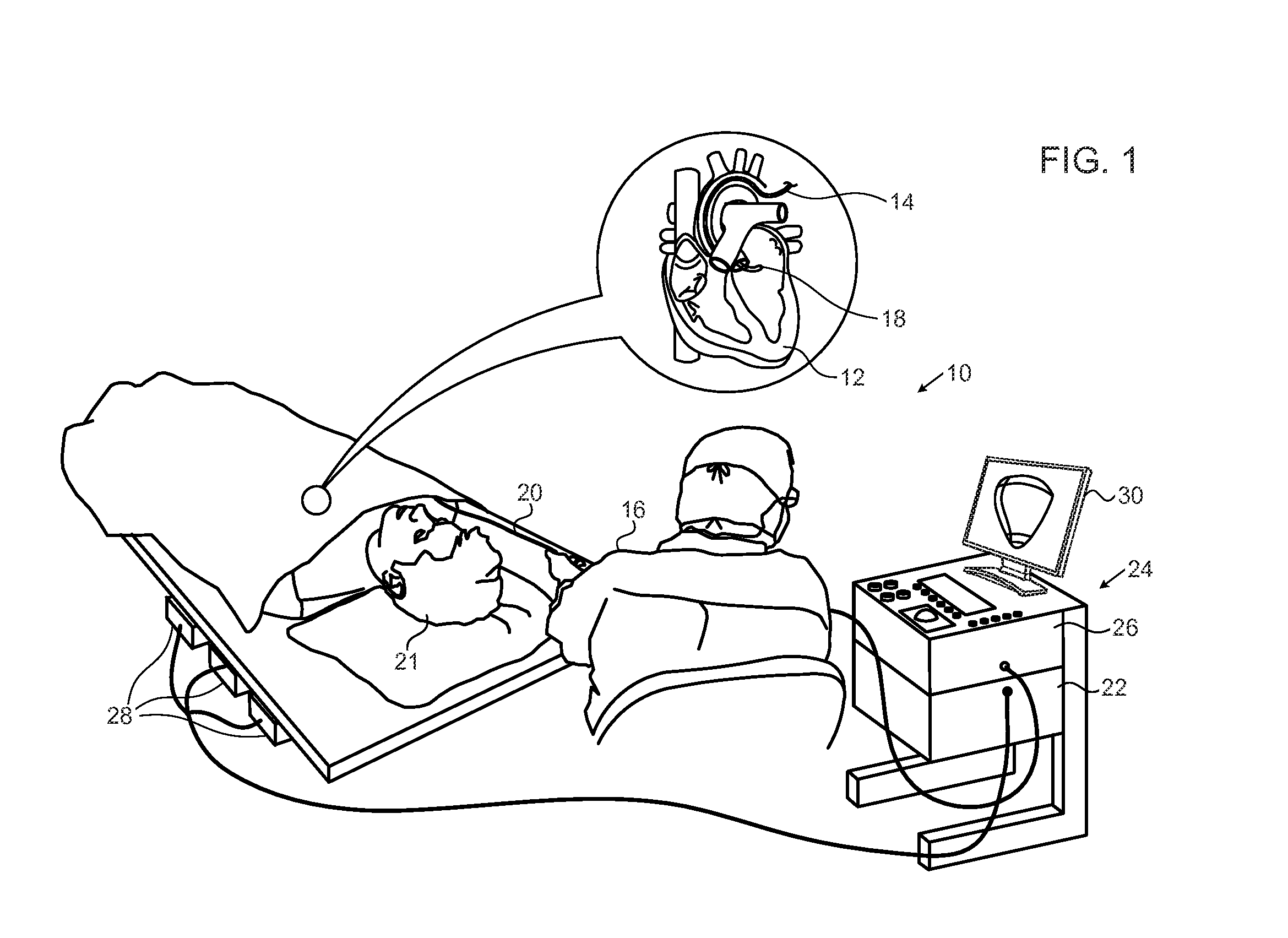 Hybrid bipolar/unipolar detection of activation wavefront