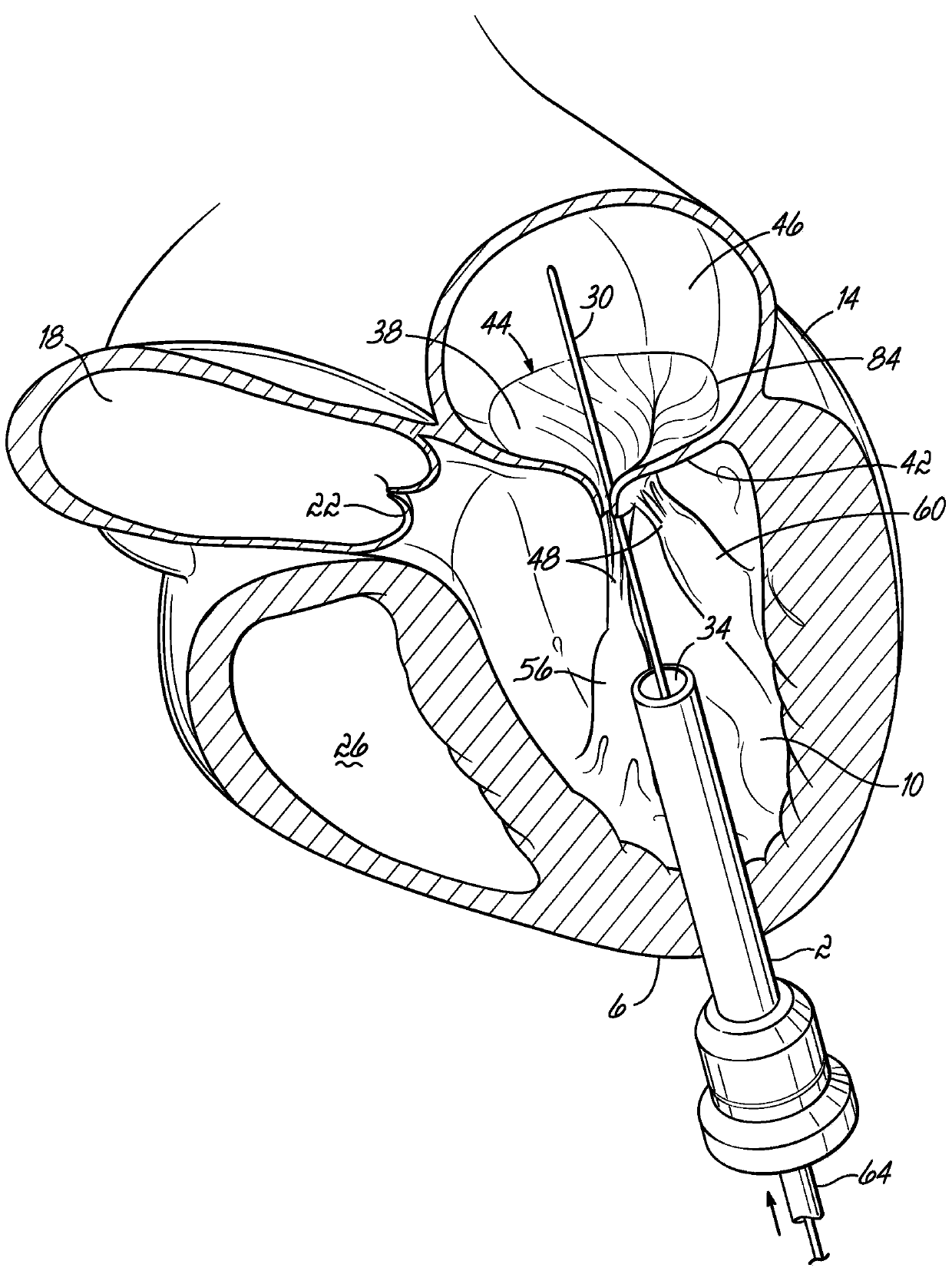 Mitral valve docking devices, systems and methods