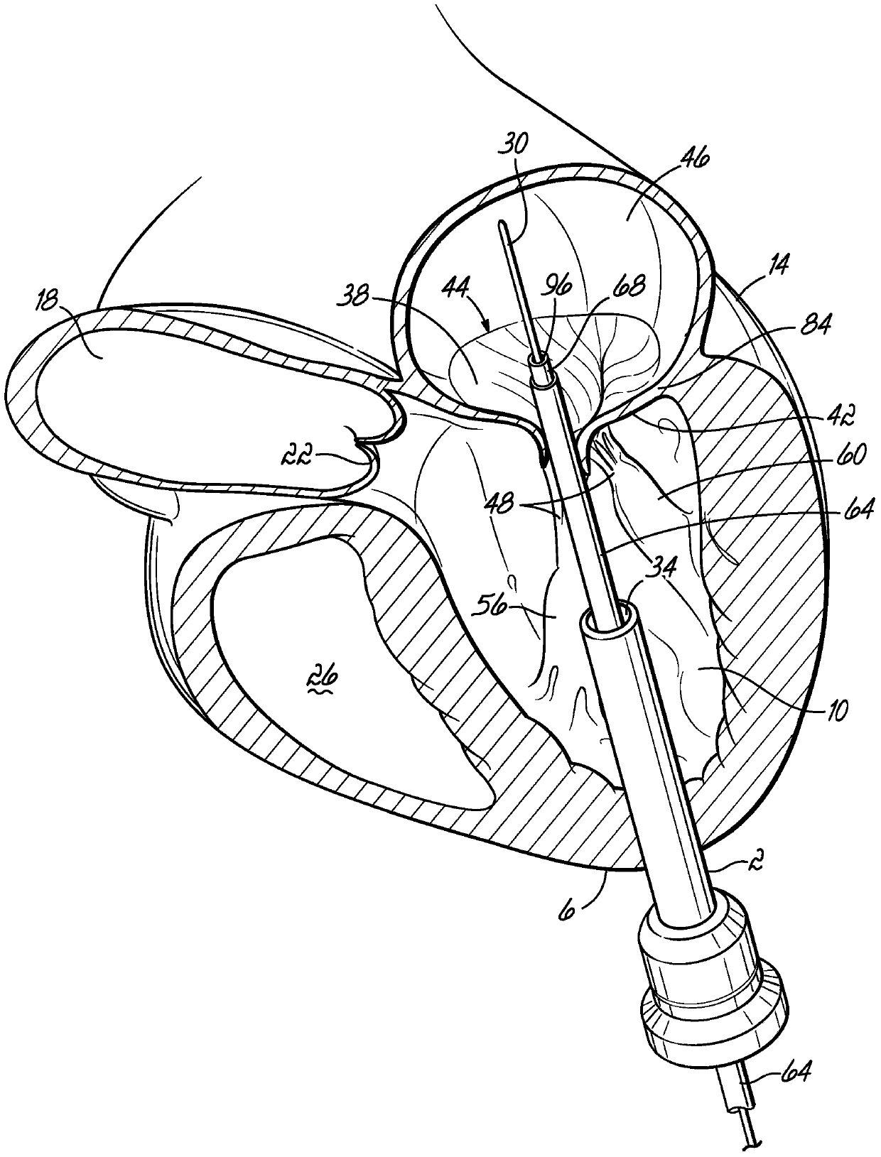 Mitral valve docking devices, systems and methods