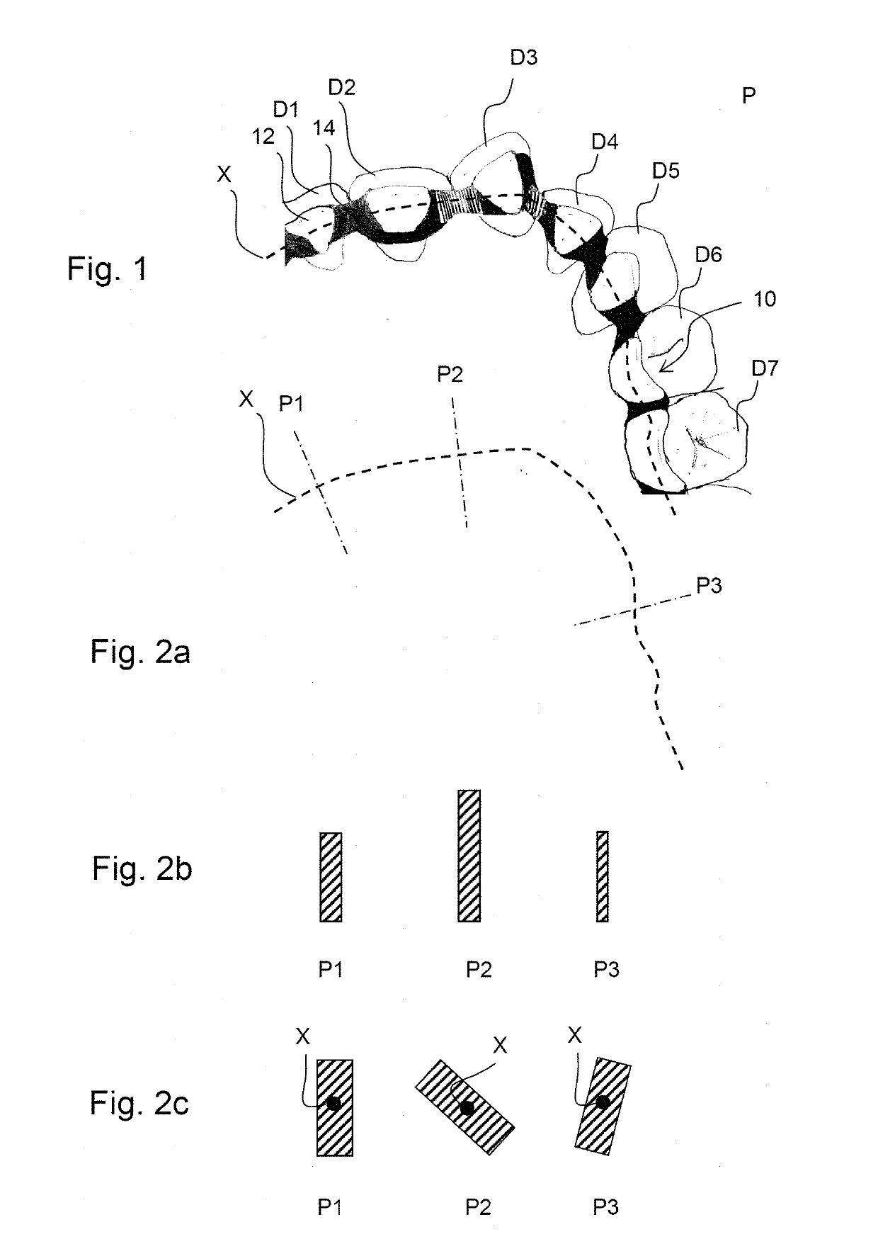 Orthodontic shape memory band