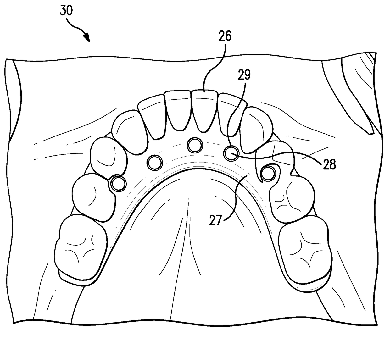 Apparatuses and methods for making a final hybrid prosthesis to be attached to dental implants