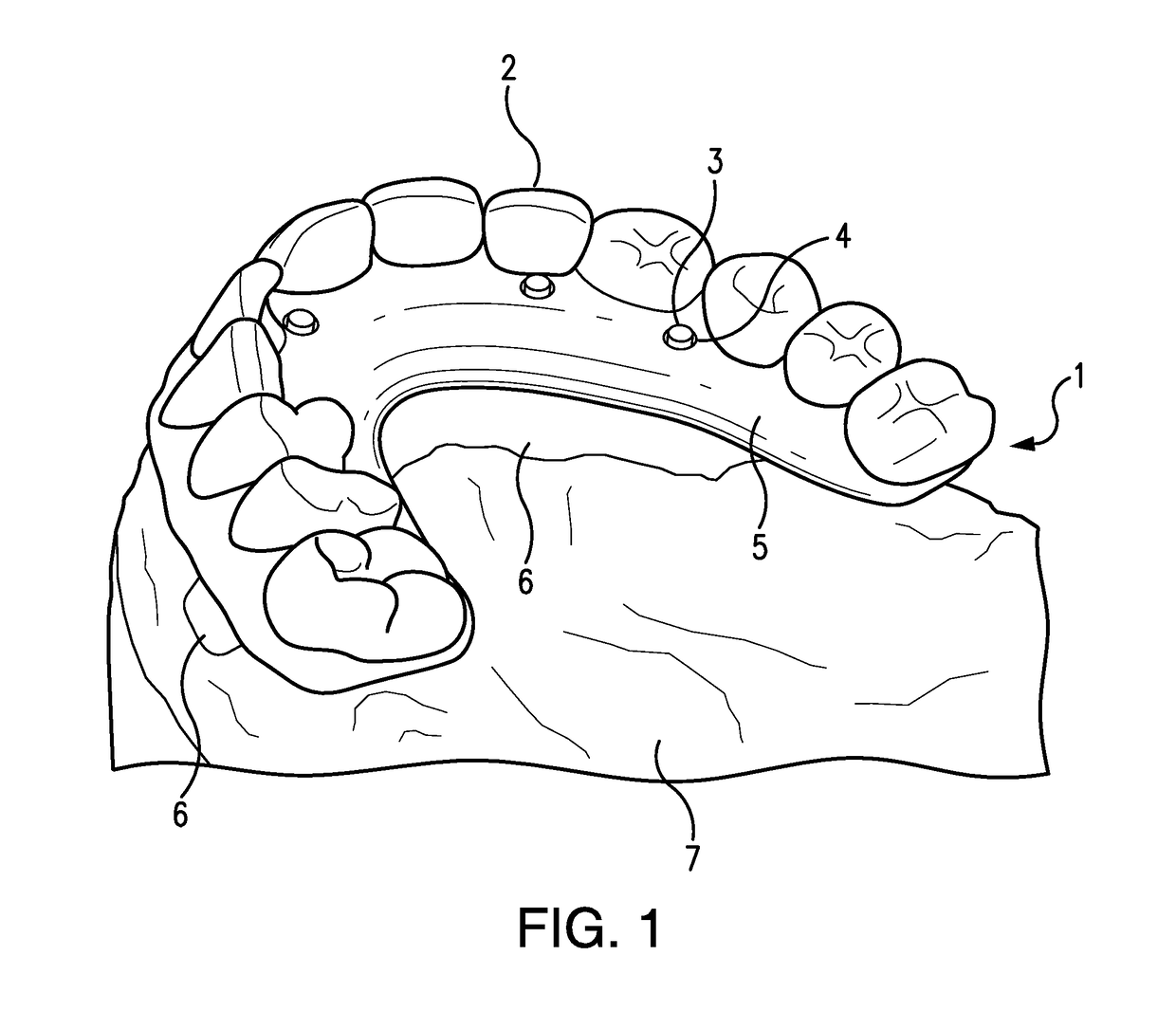 Apparatuses and methods for making a final hybrid prosthesis to be attached to dental implants