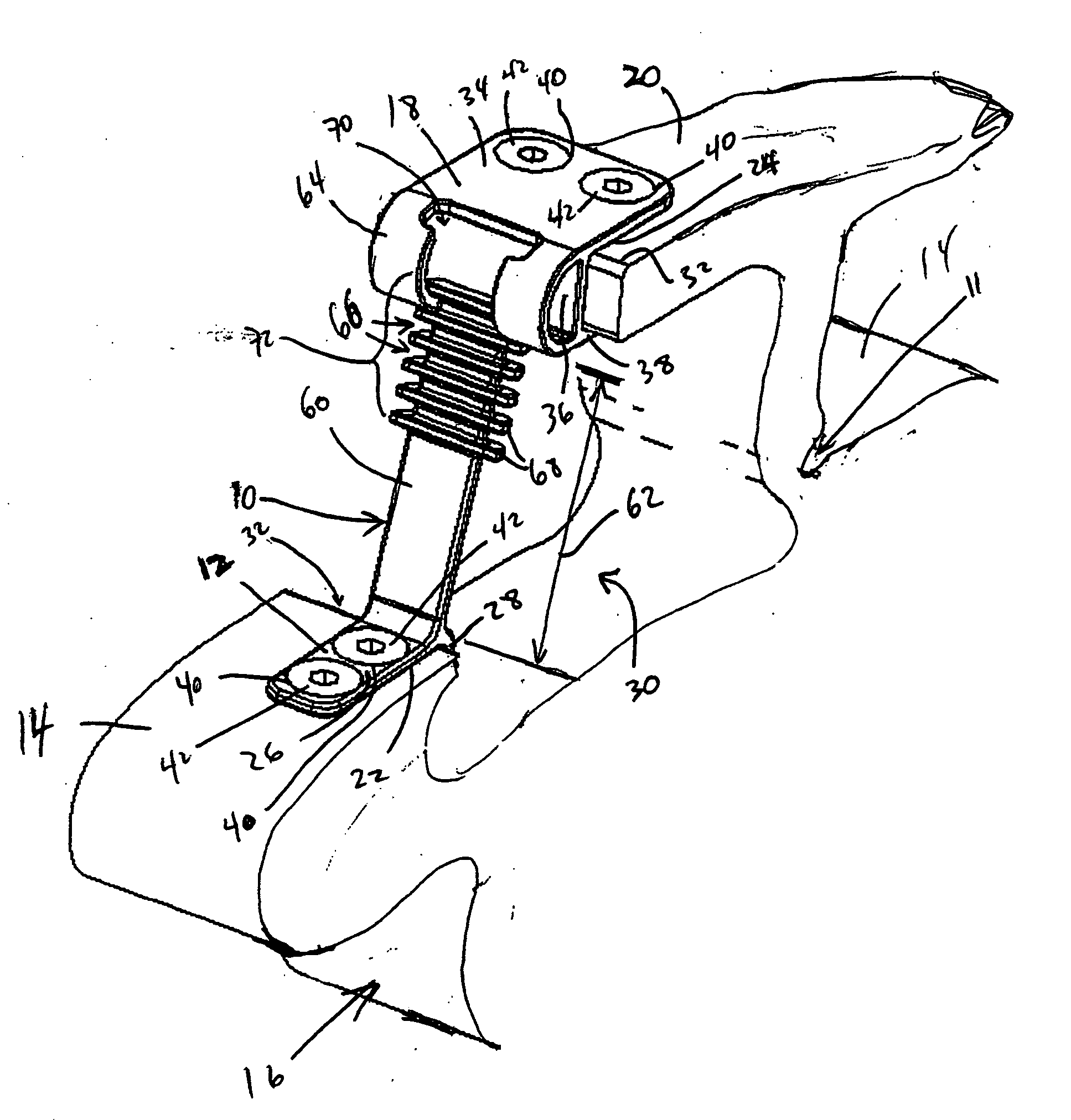 Variable laminoplasty implant