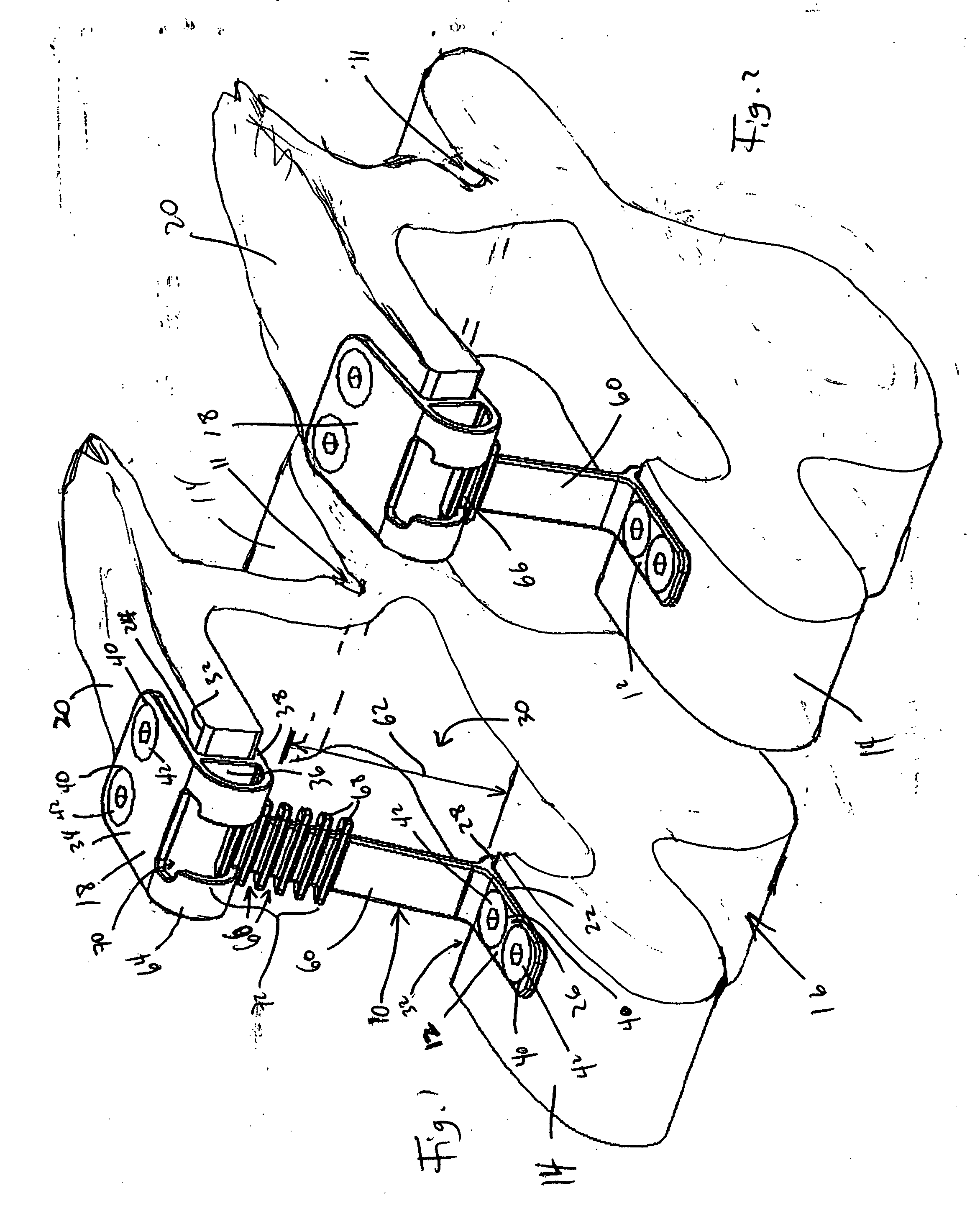 Variable laminoplasty implant