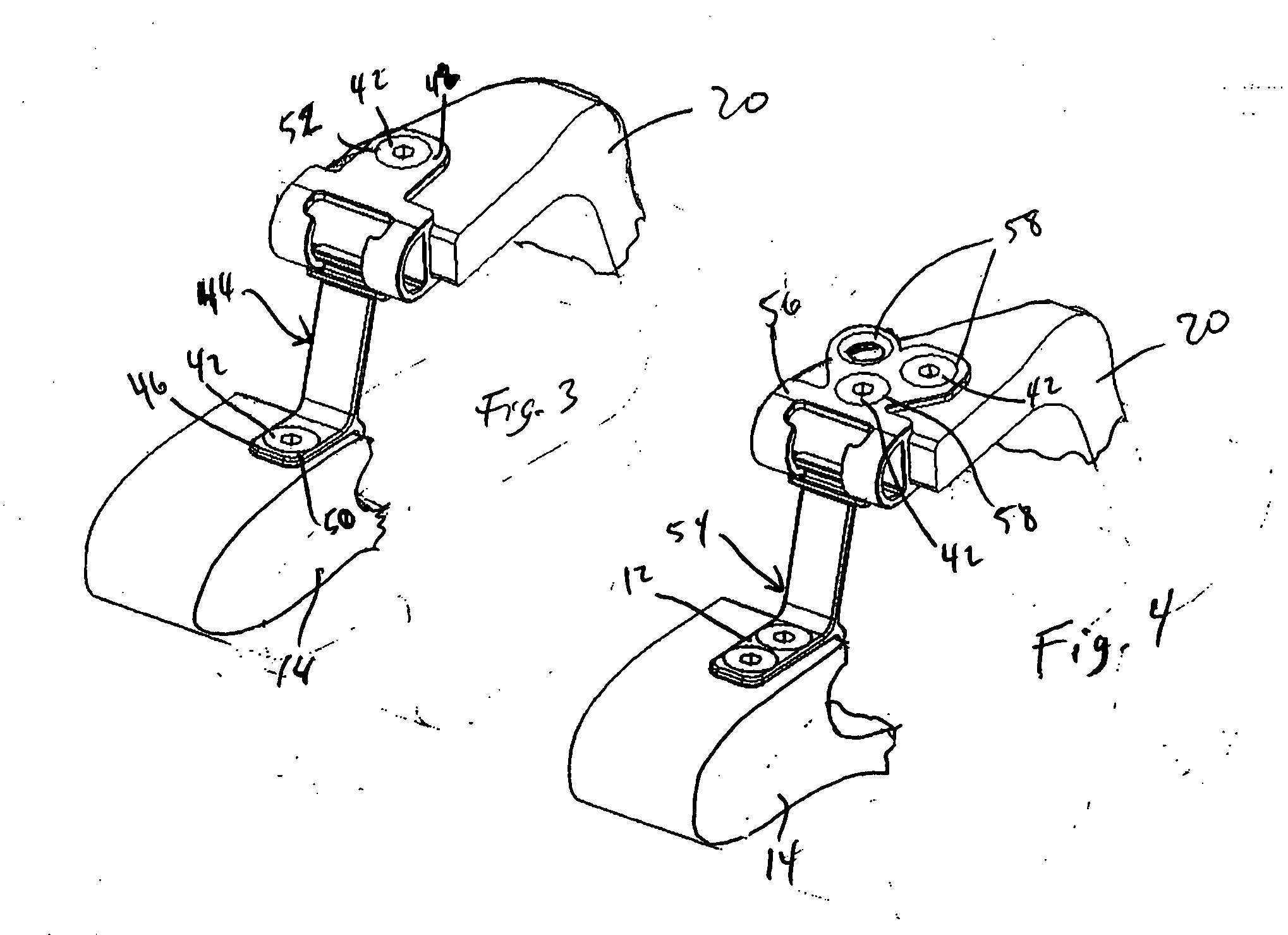 Variable laminoplasty implant