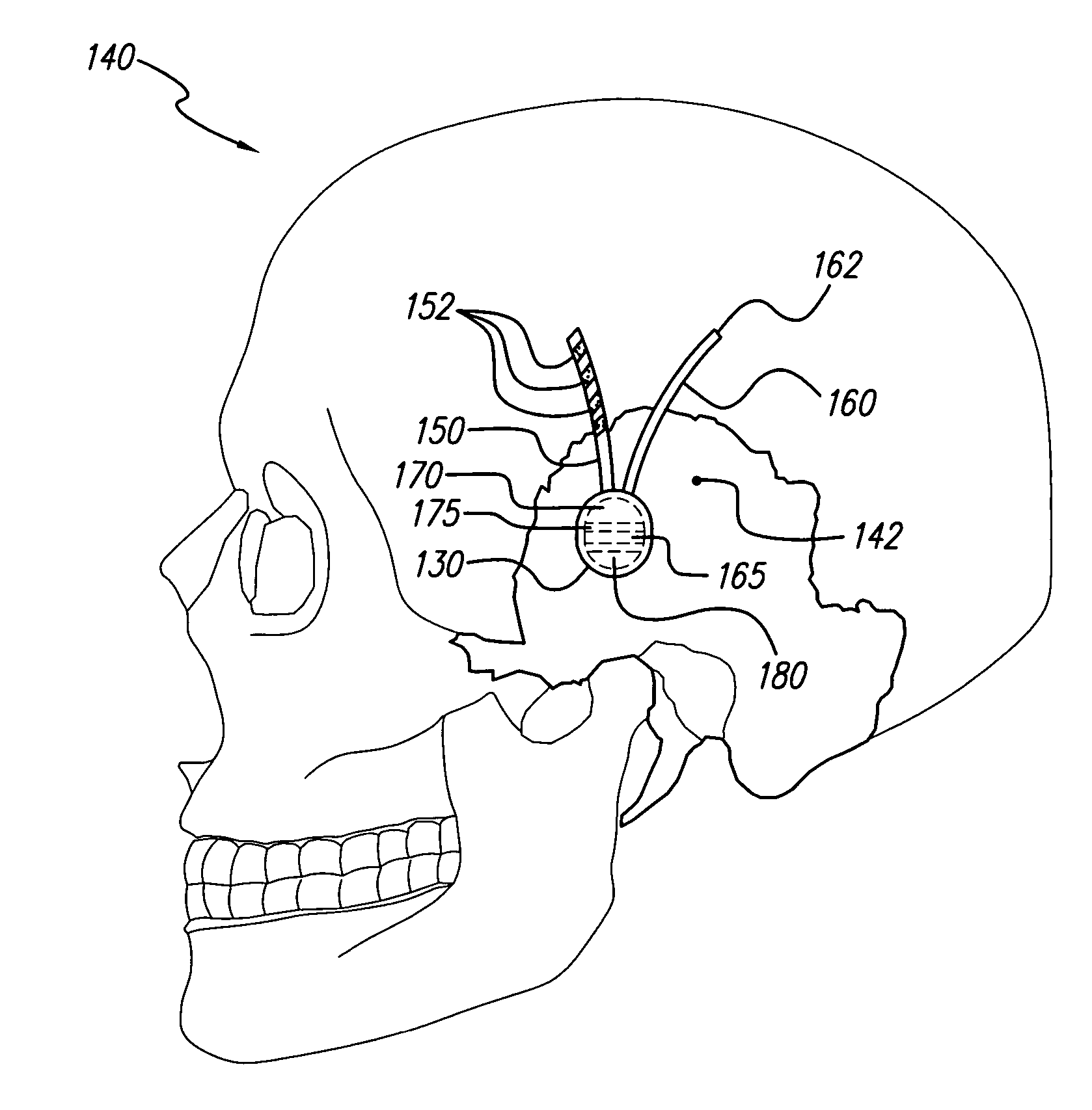 Treatment of mood and/or anxiety disorders by electrical brain stimulation and/or drug infusion